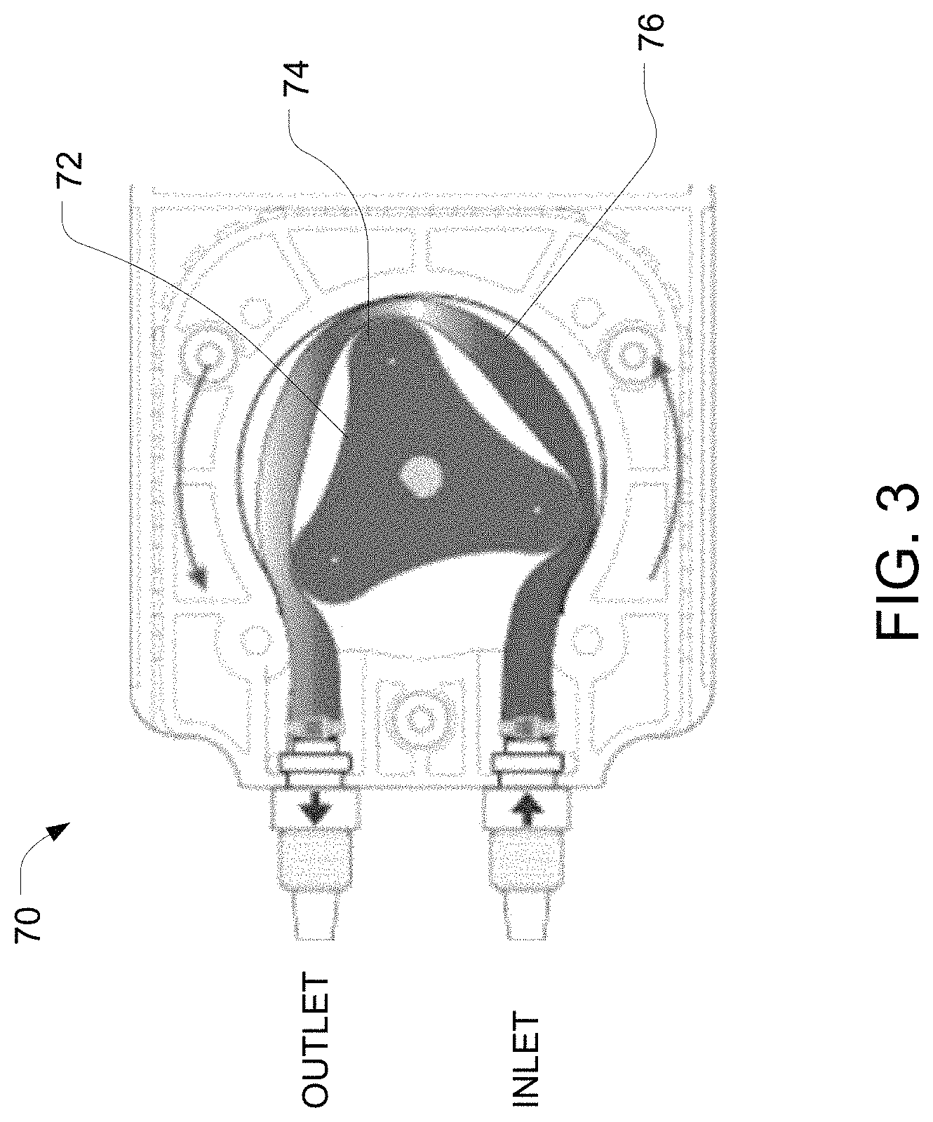 Patent US11771437 Figure 3 – Dual-pump system for delivering embolic beads or other therapeutic substances into an artery