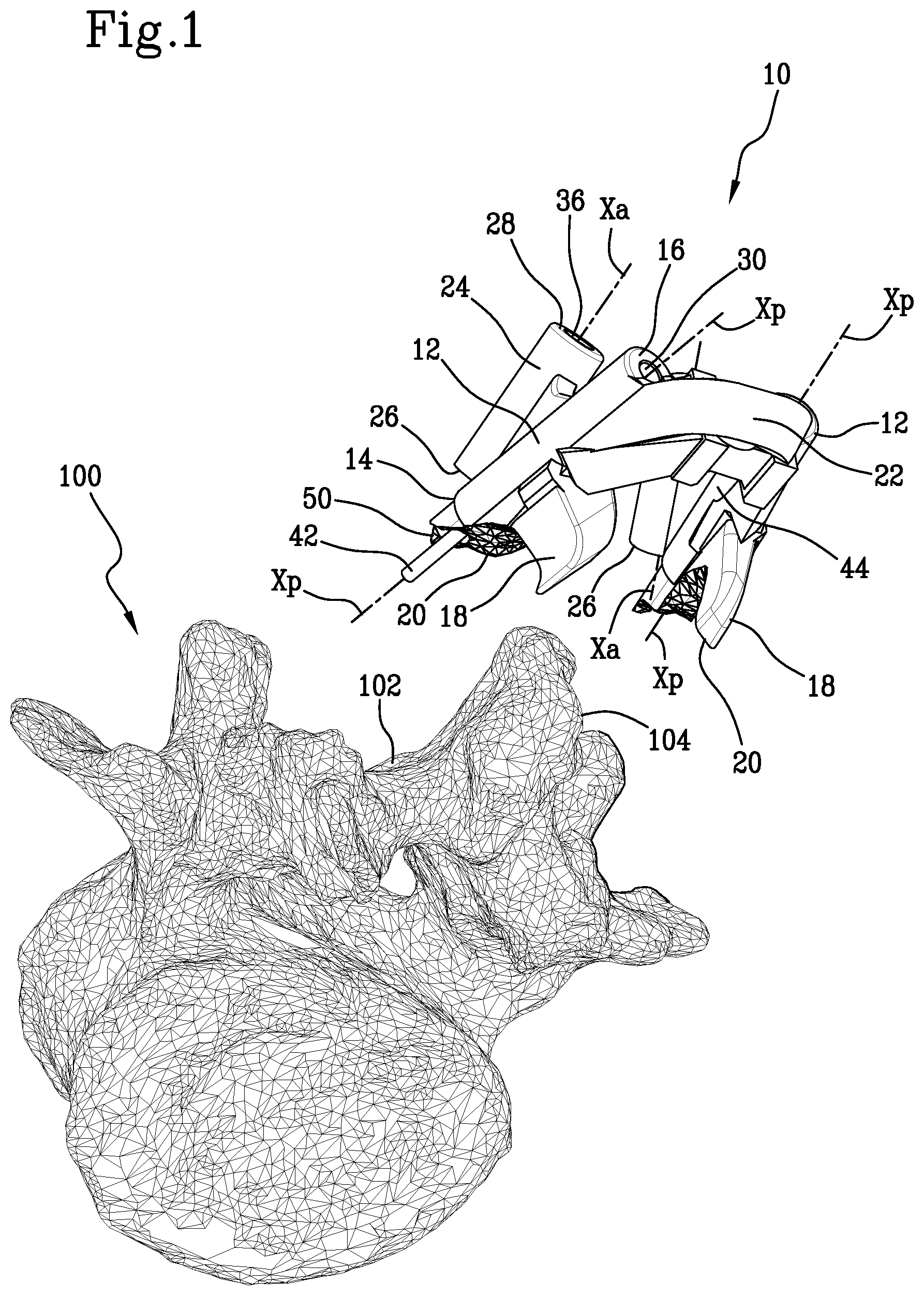 Patent US11771441 Figure 1 – Specific disposable guide device for spinal surgery
