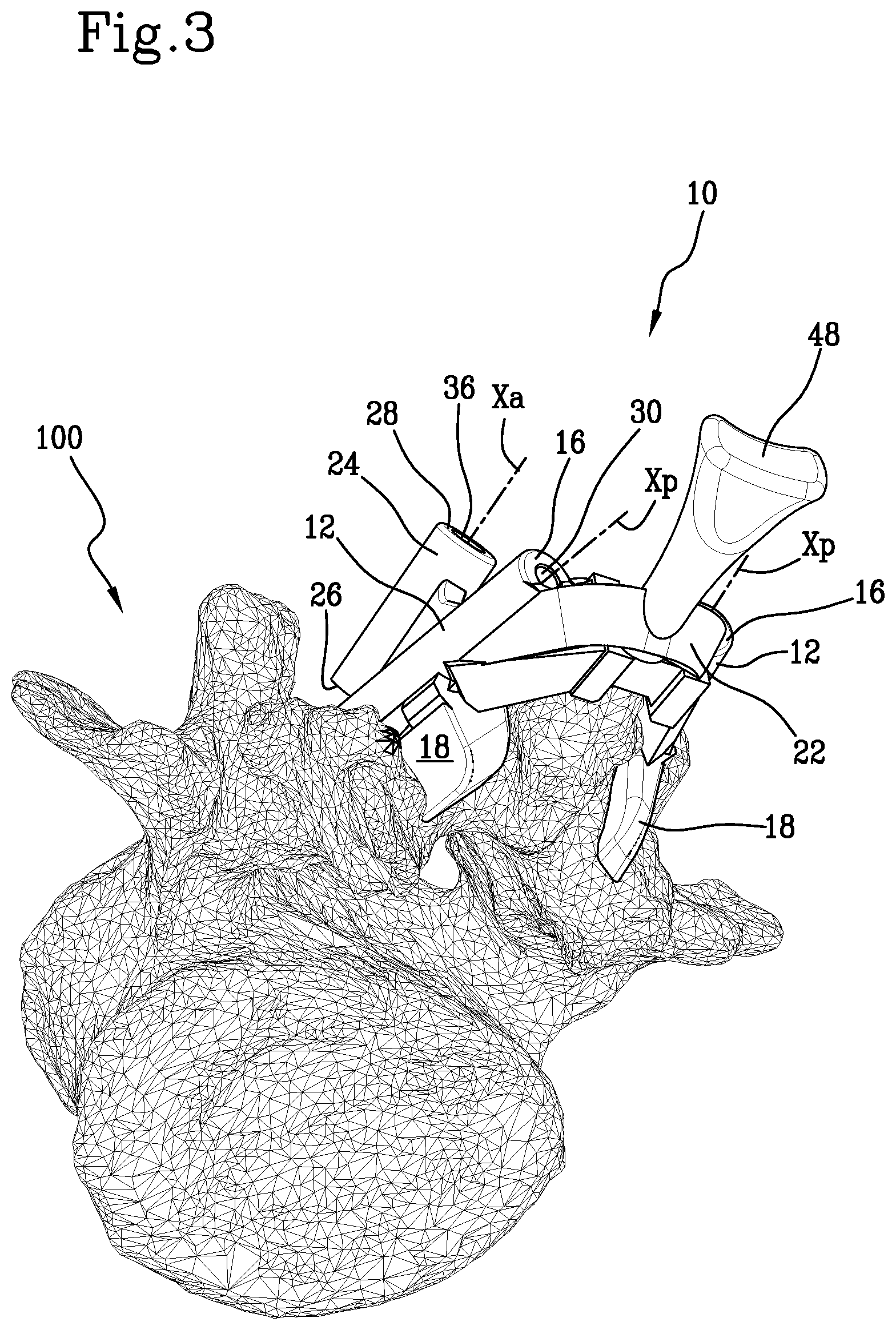 Patent US11771441 Figure 3 – Specific disposable guide device for spinal surgery