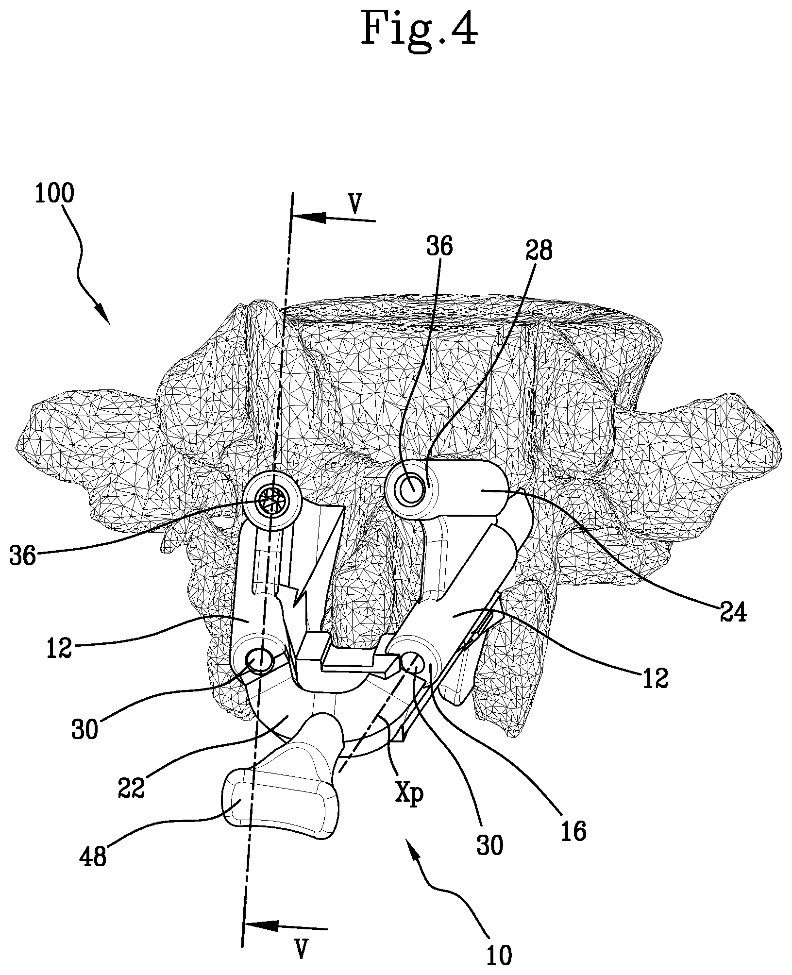 Patent US11771441 Figure 4 – Specific disposable guide device for spinal surgery