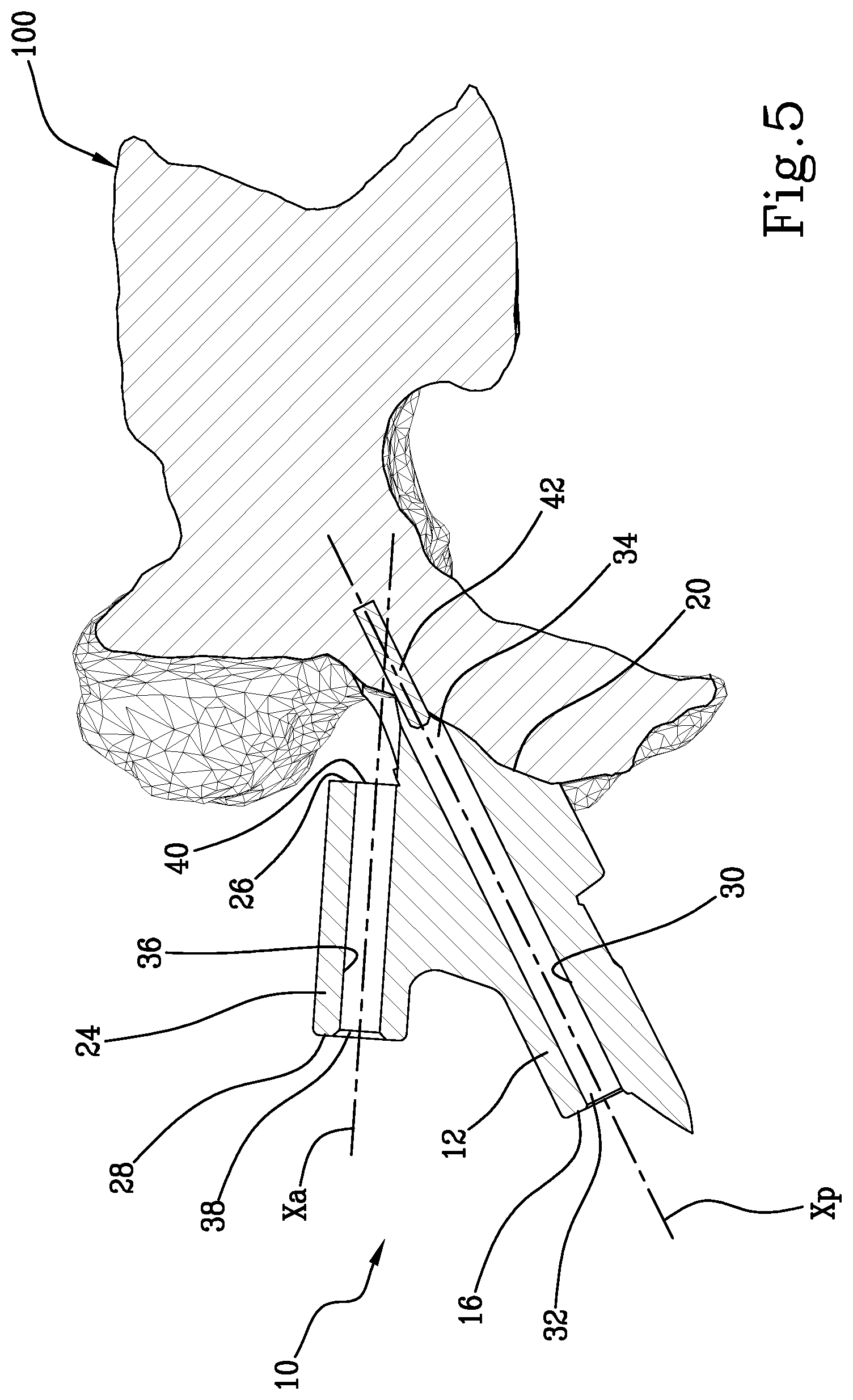 Patent US11771441 Figure 5 – Specific disposable guide device for spinal surgery