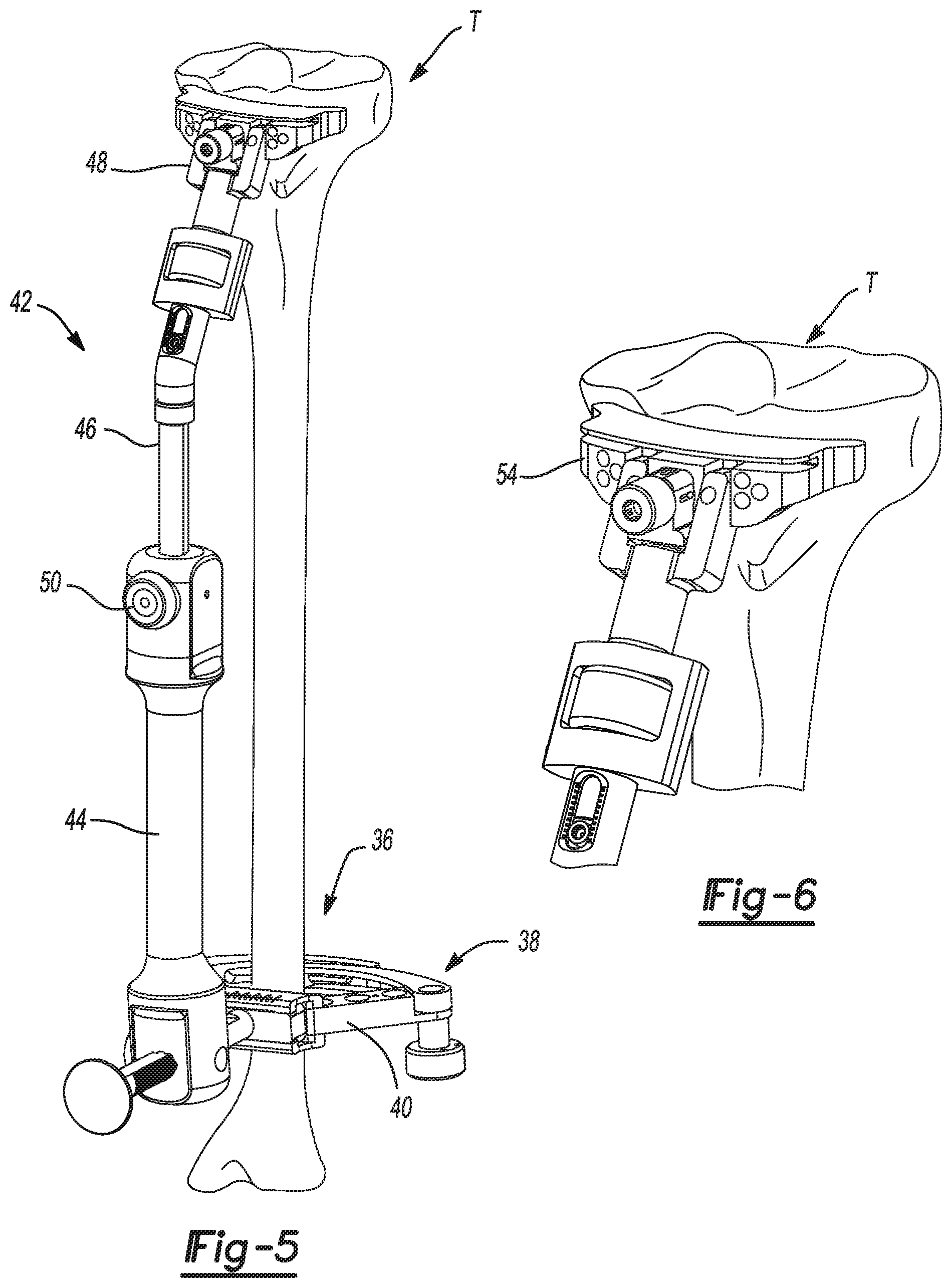 Patent US11771442 Figure 2 – Bi-cruciate knee system
