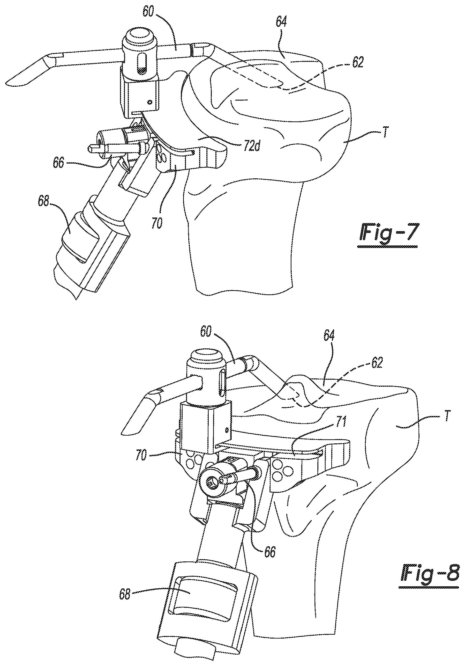 Patent US11771442 Figure 3 – Bi-cruciate knee system