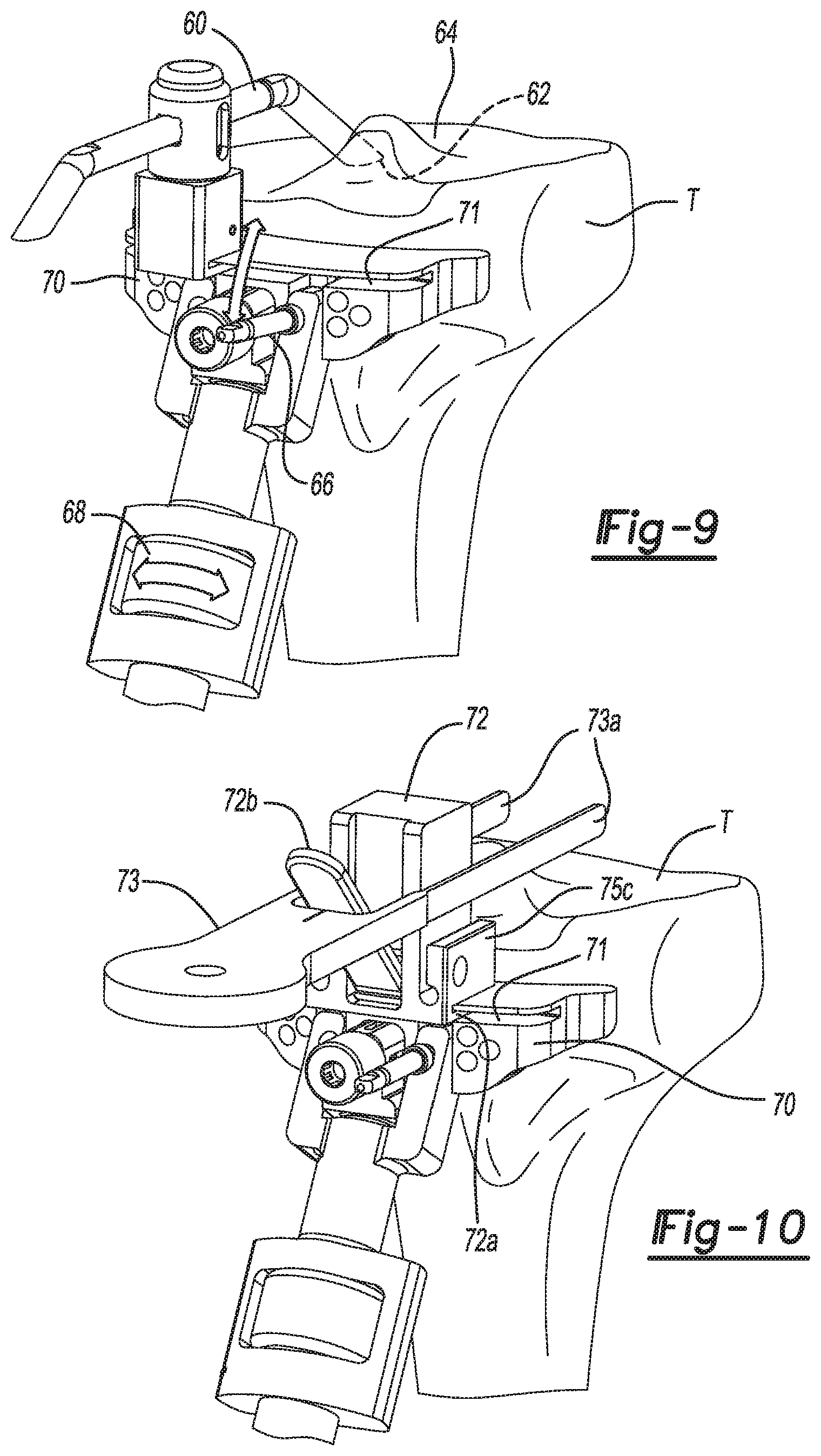 Patent US11771442 Figure 4 – Bi-cruciate knee system