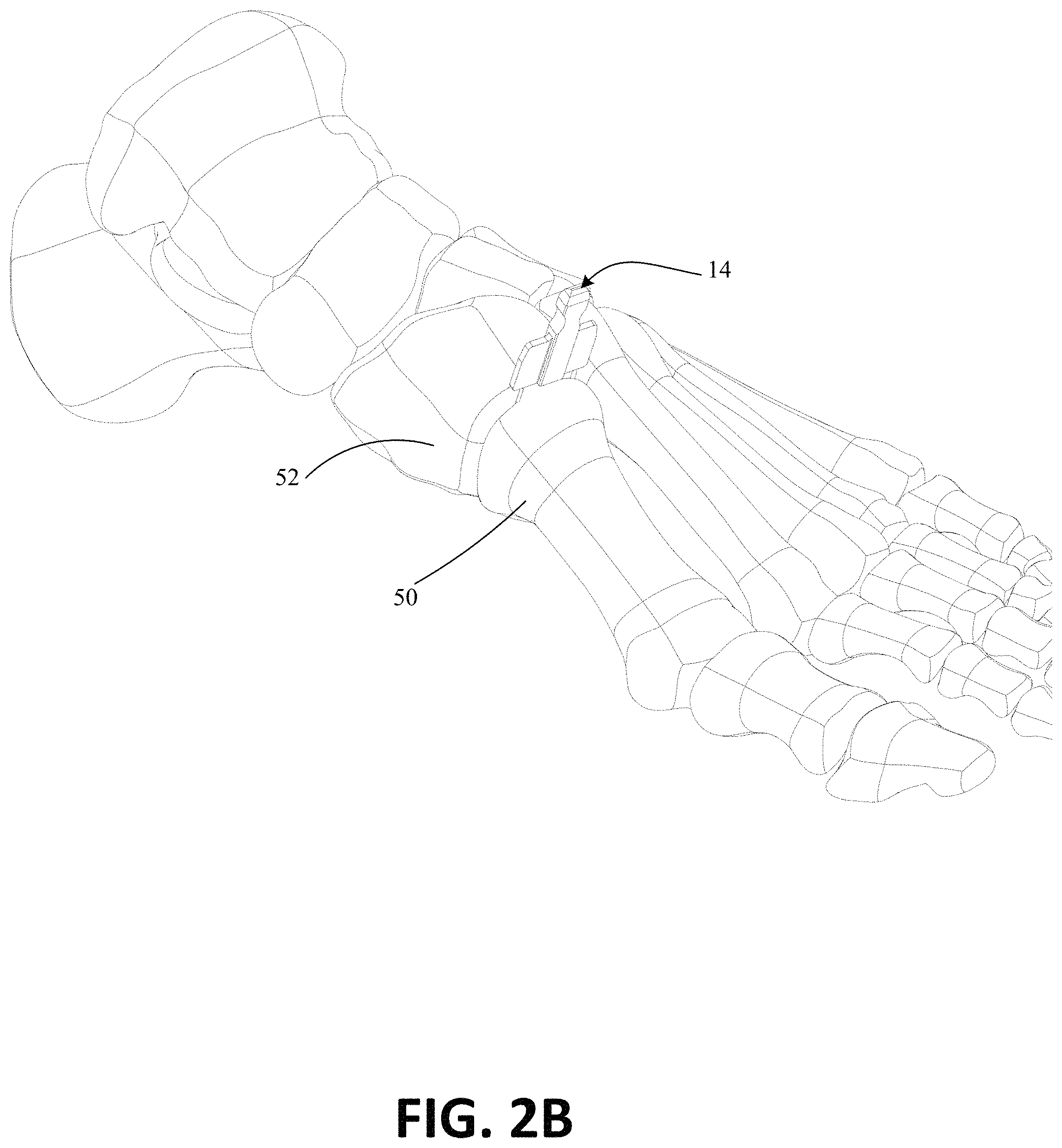 Patent US11771443 Figure 3 – Joint spacer systems and methods