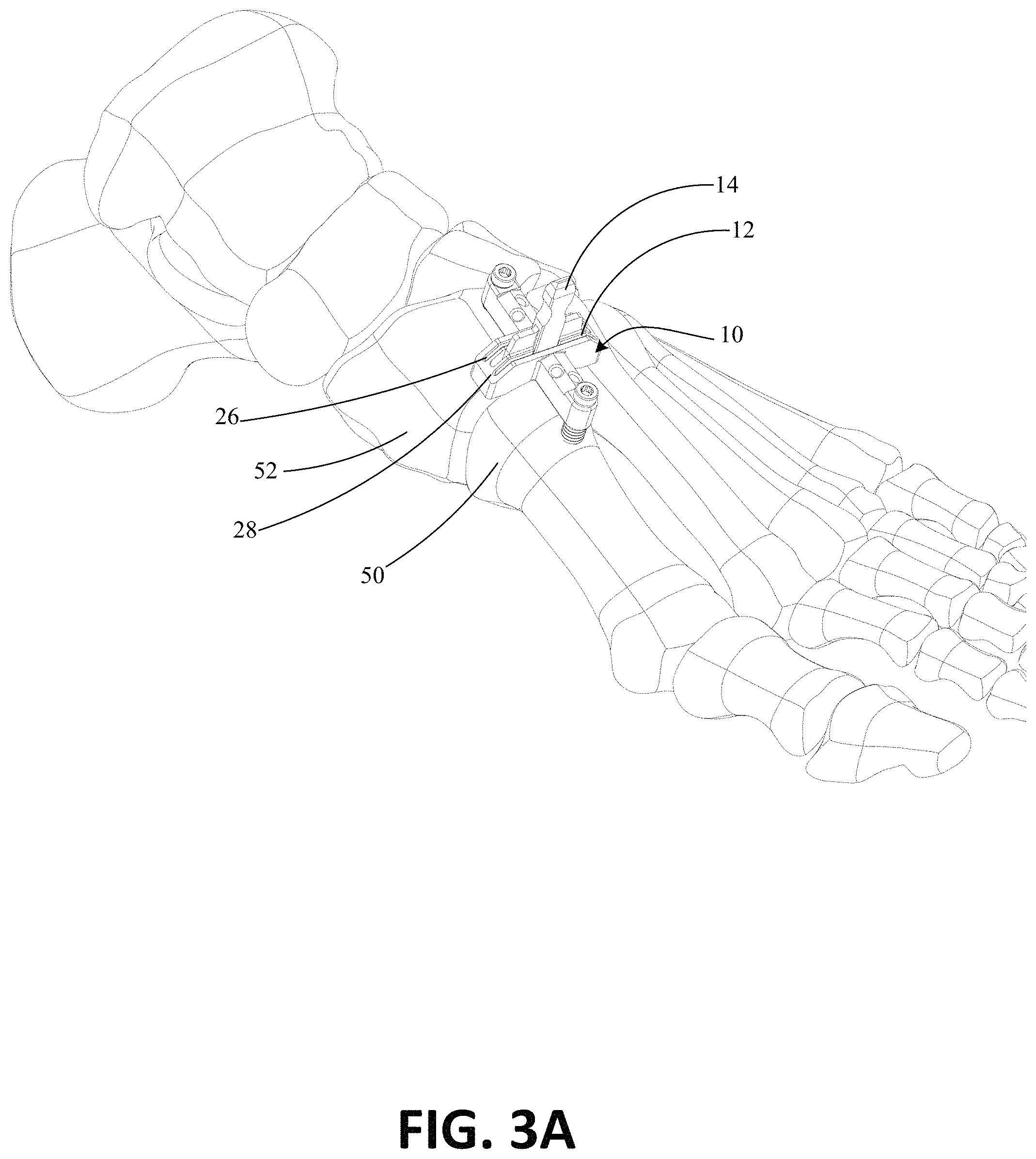 Patent US11771443 Figure 4 – Joint spacer systems and methods
