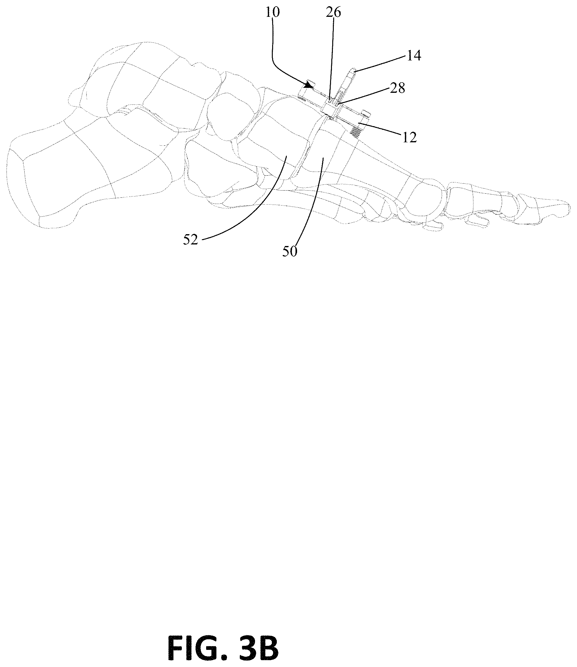Patent US11771443 Figure 5 – Joint spacer systems and methods