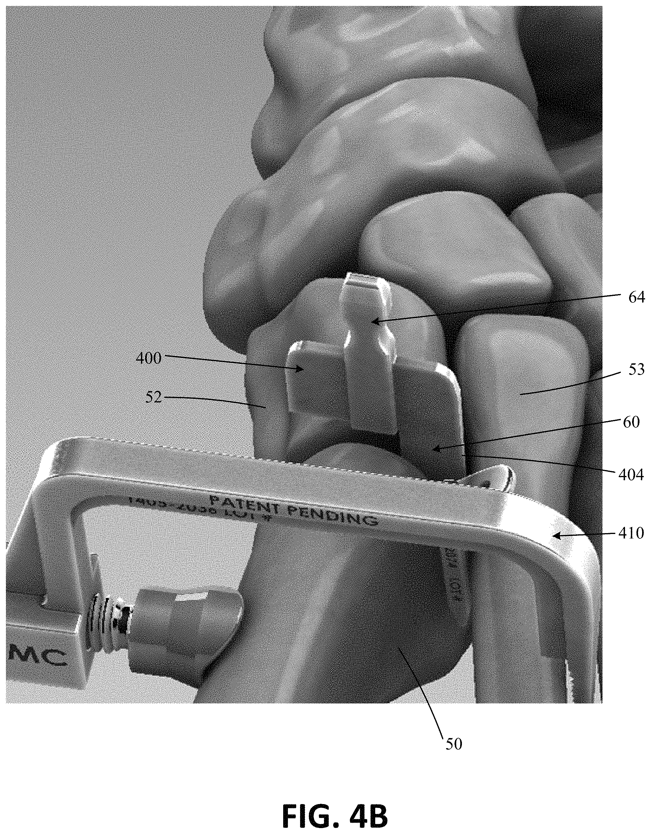 Patent US11771443 Figure 7 – Joint spacer systems and methods