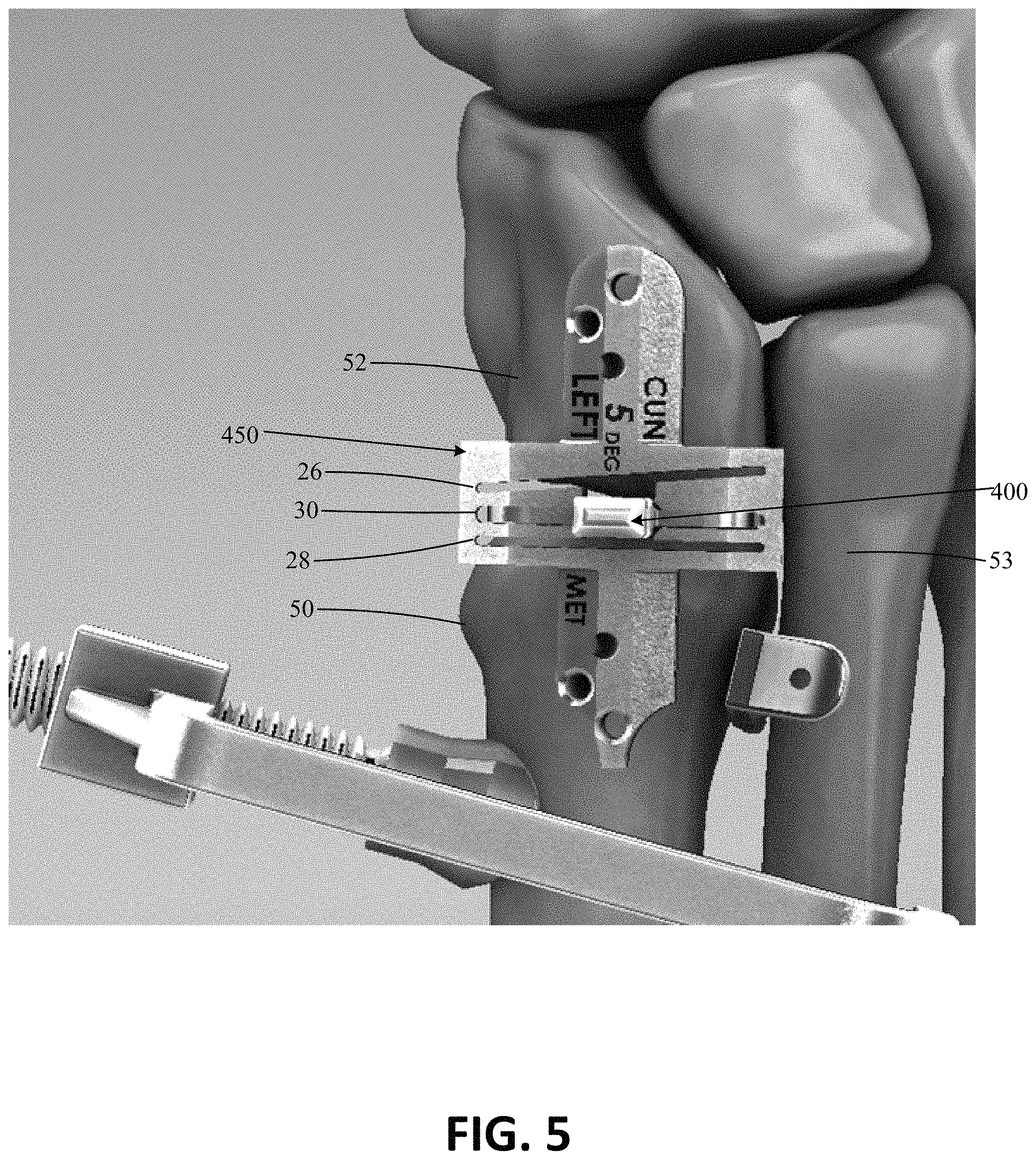 Patent US11771443 Figure 11 – Joint spacer systems and methods