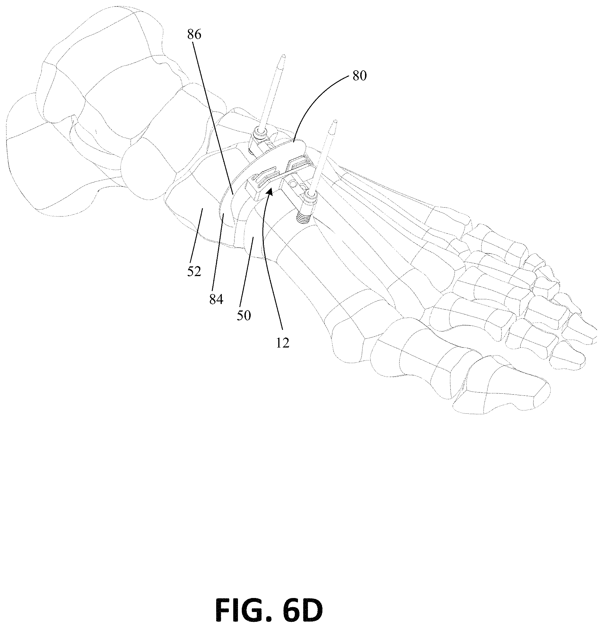 Patent US11771443 Figure 15 – Joint spacer systems and methods