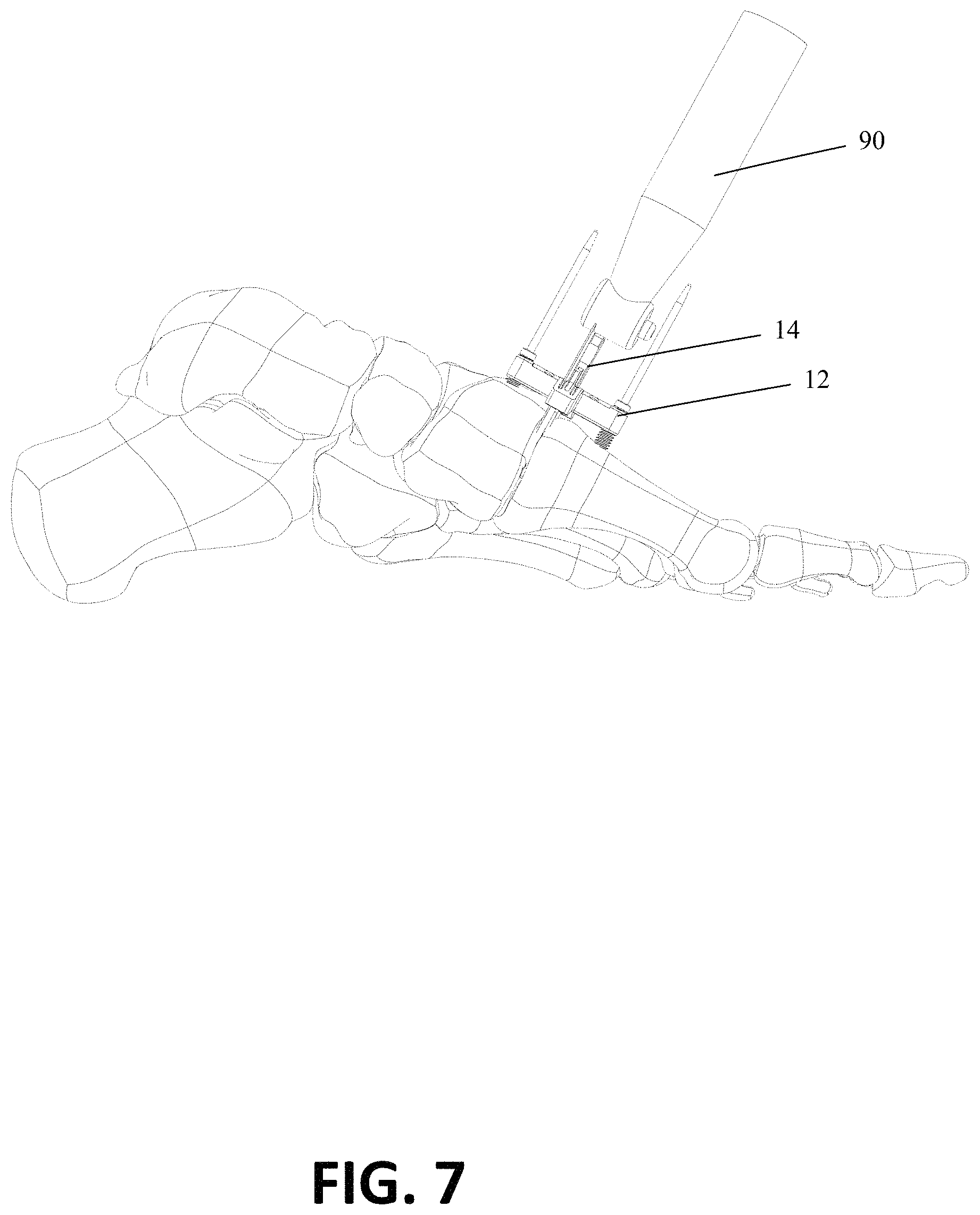 Patent US11771443 Figure 16 – Joint spacer systems and methods
