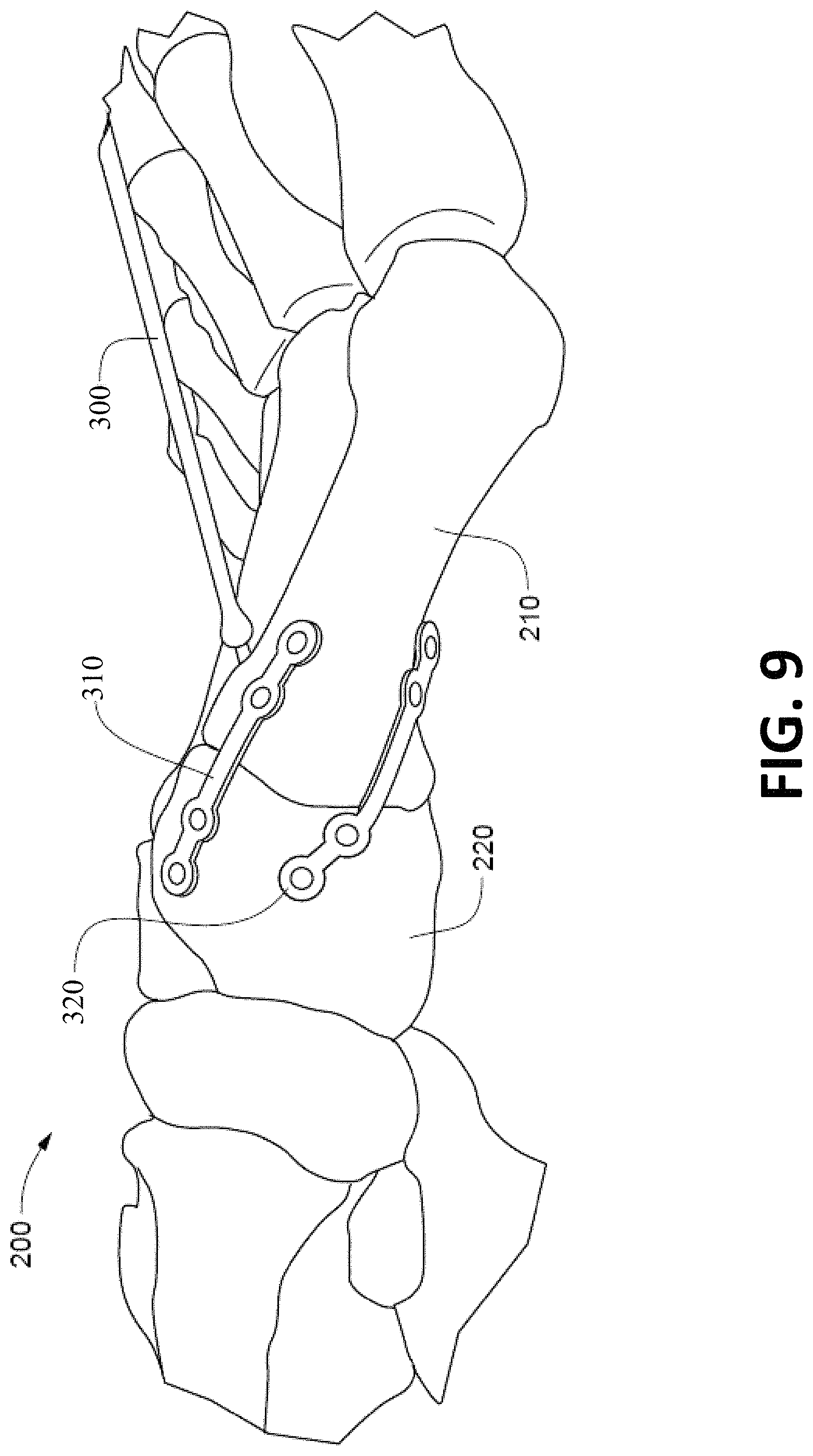 Patent US11771443 Figure 18 – Joint spacer systems and methods