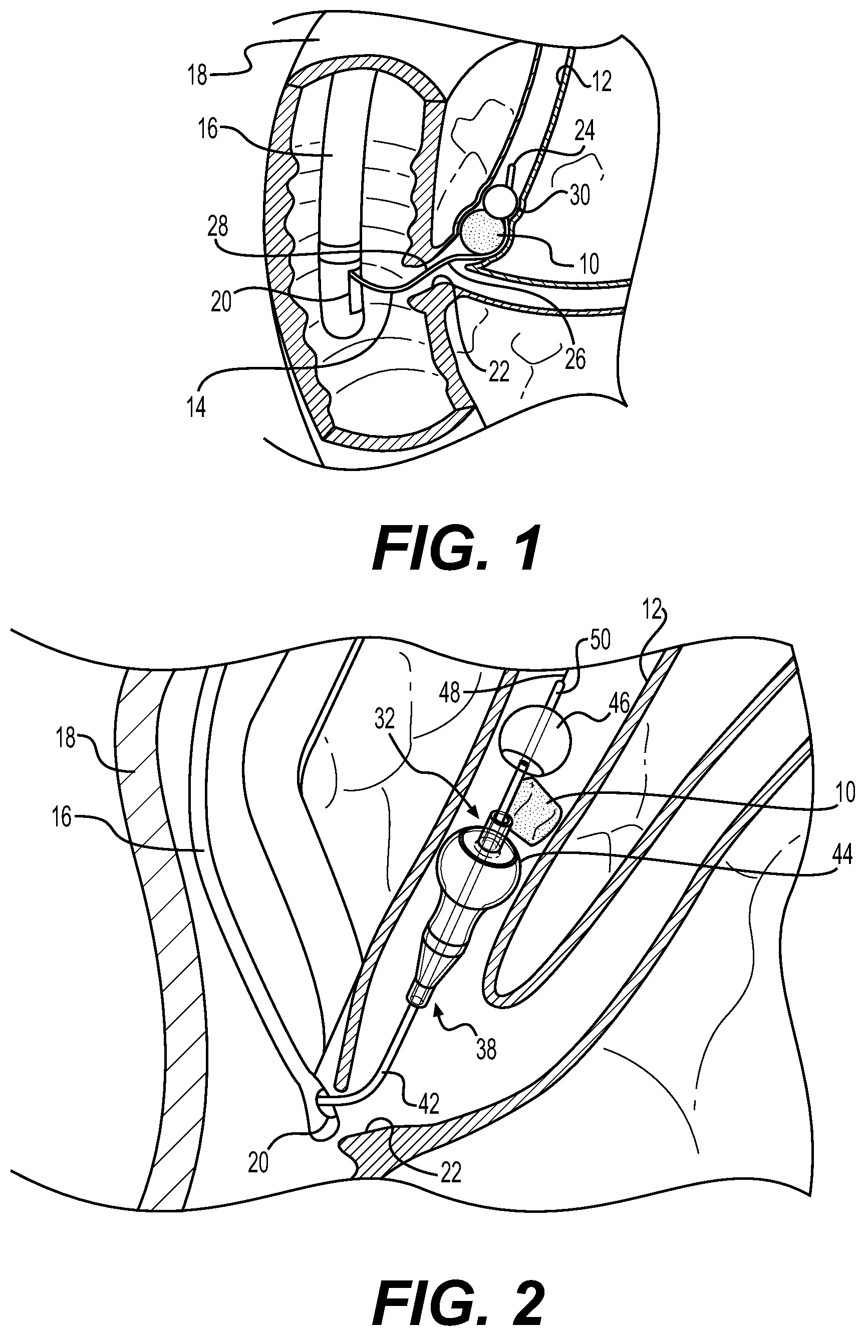 Patent US11771444 Figure 1 – Medical instrument having a balloon and an extraction member