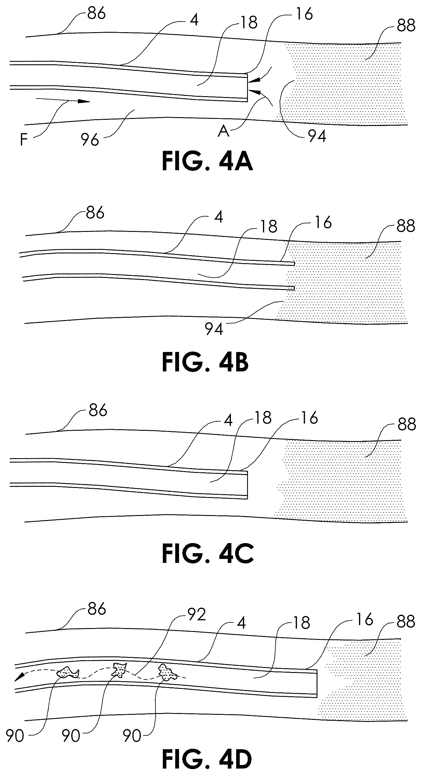 Patent US11771445 Figure 5 – Aspiration monitoring system and method