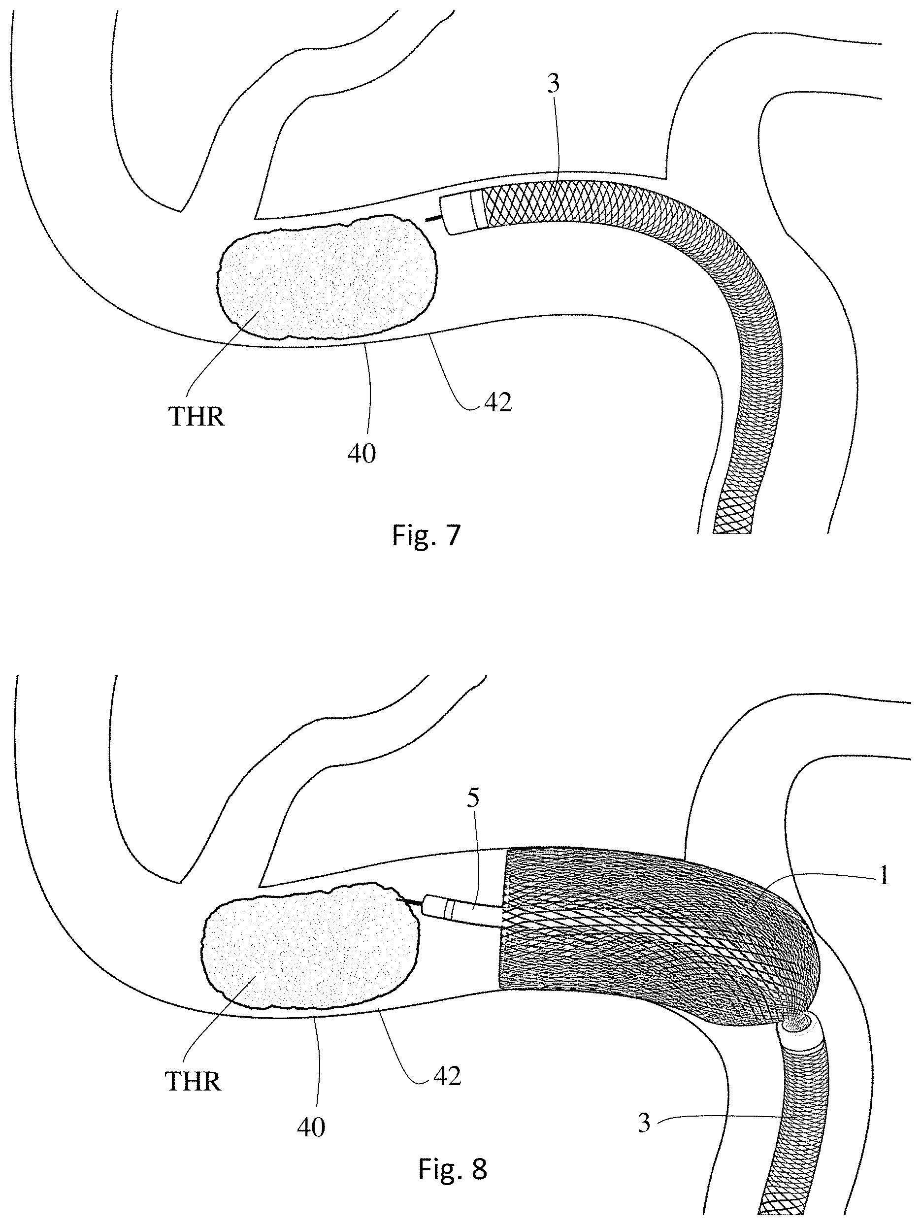 Patent US11771446 Figure 4 – Thrombectomy system and method of use