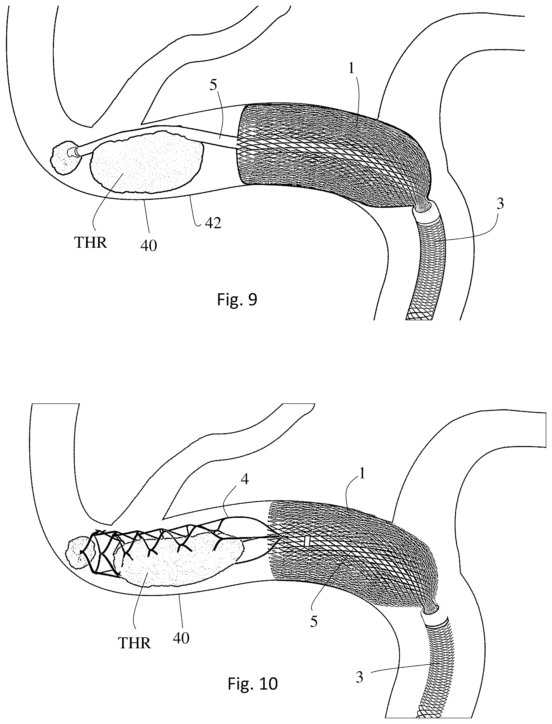 Patent US11771446 Figure 5 – Thrombectomy system and method of use