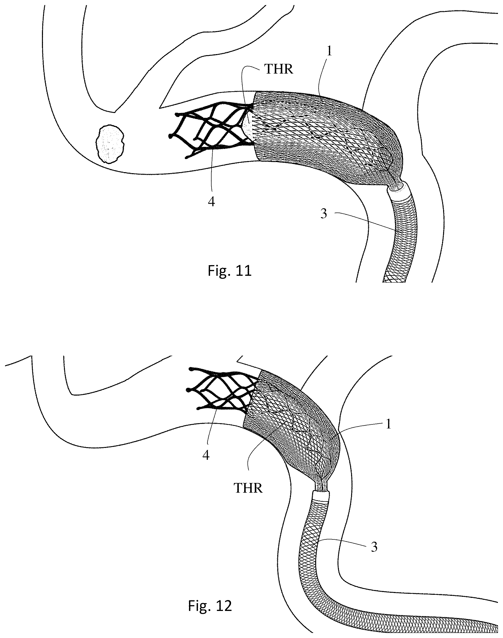Patent US11771446 Figure 6 – Thrombectomy system and method of use