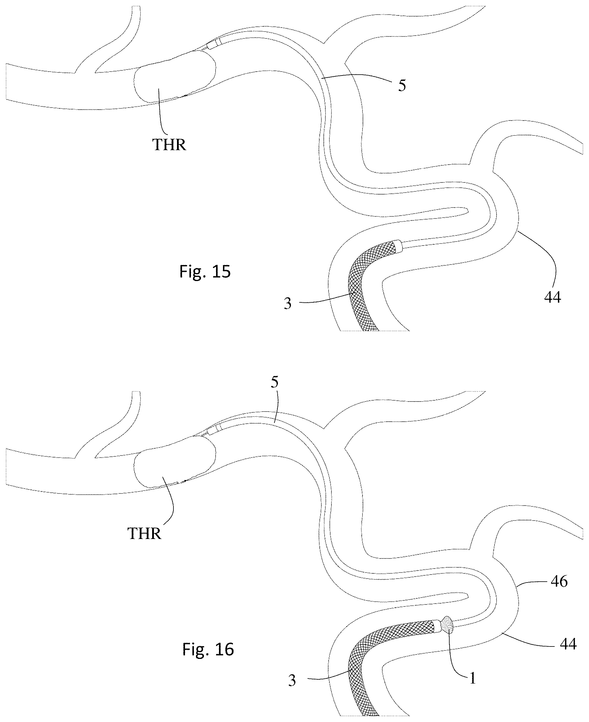 Patent US11771446 Figure 8 – Thrombectomy system and method of use