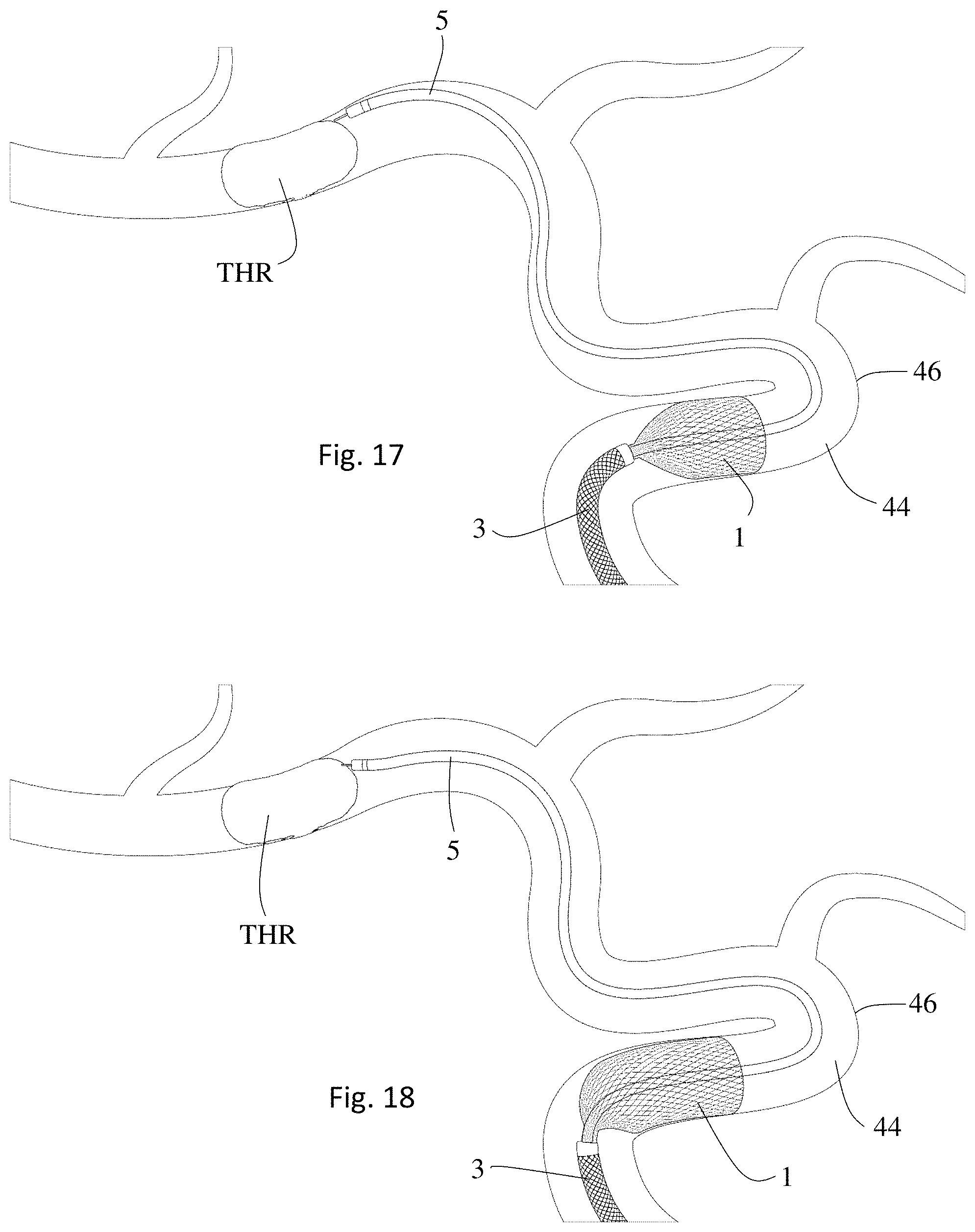 Patent US11771446 Figure 9 – Thrombectomy system and method of use