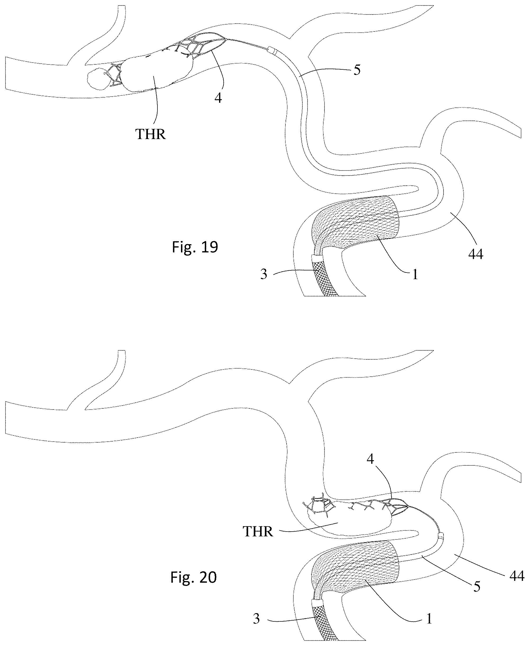 Patent US11771446 Figure 10 – Thrombectomy system and method of use