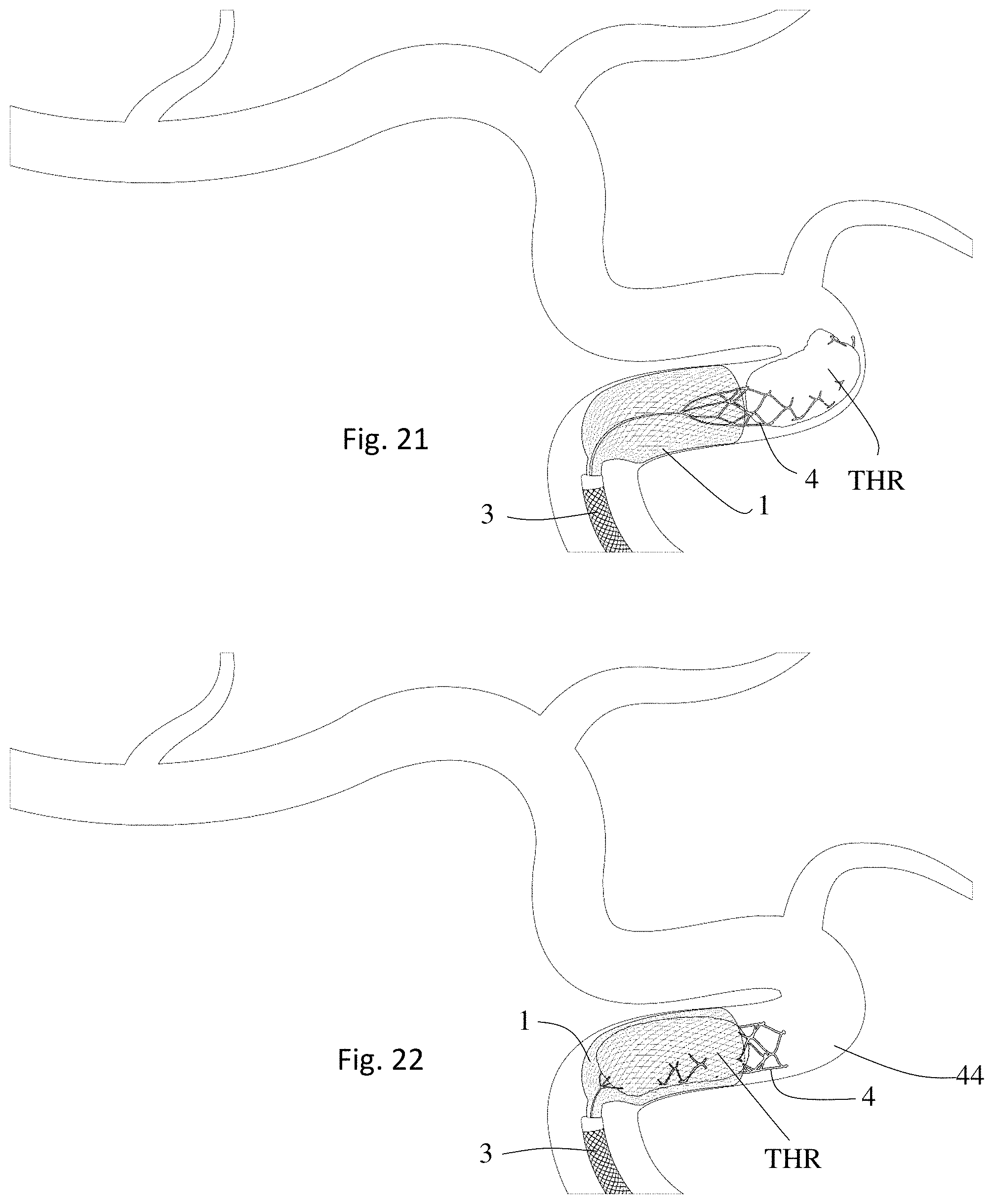 Patent US11771446 Figure 11 – Thrombectomy system and method of use
