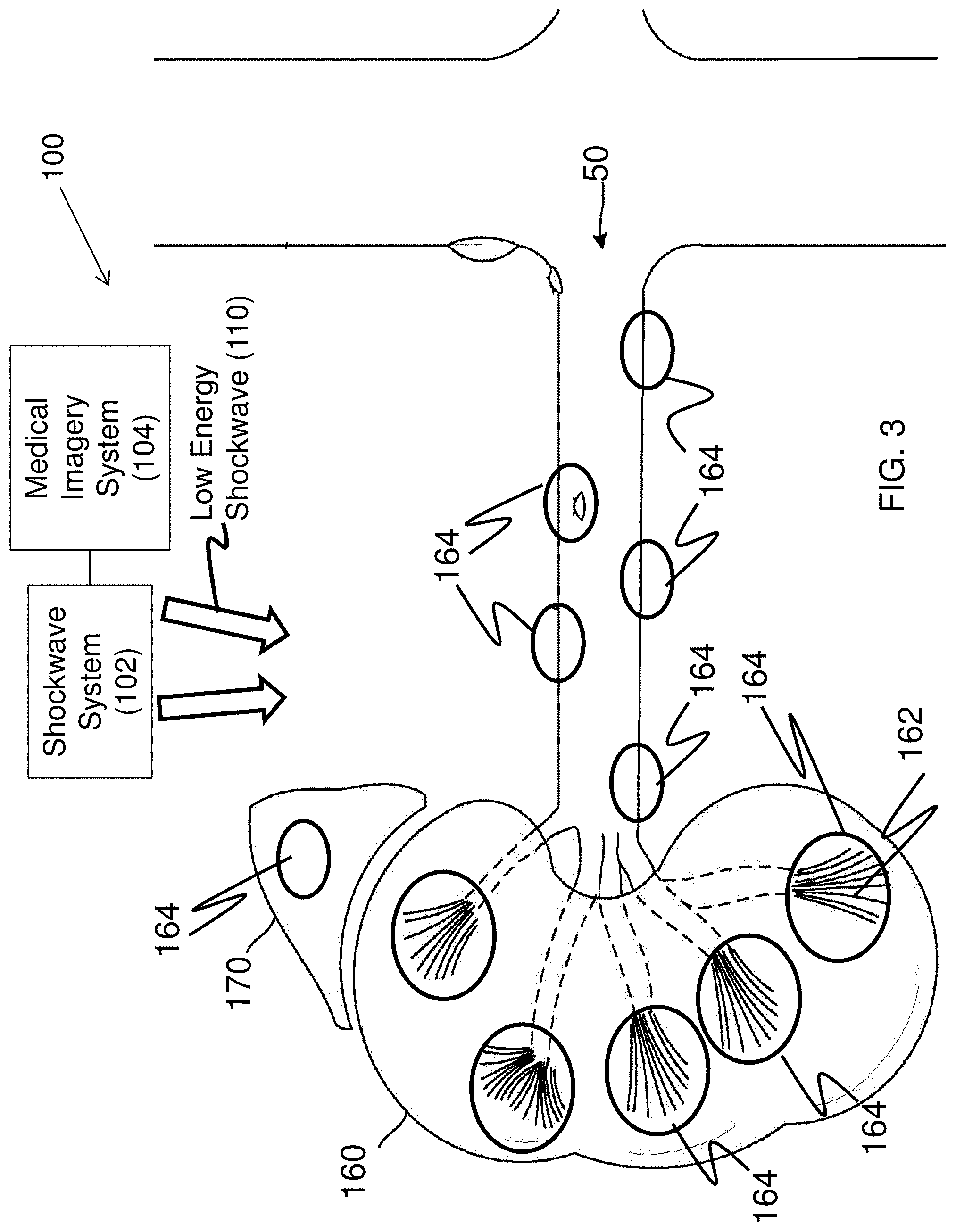 Patent US11771447 Figure 2 – Method of treatment with low energy extracorporeal shockwaves