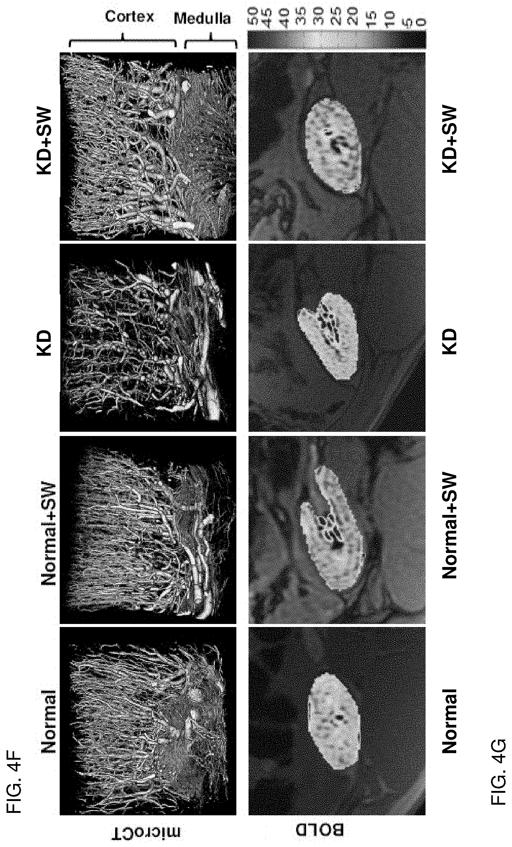 Patent US11771447 Figure 4 – Method of treatment with low energy extracorporeal shockwaves