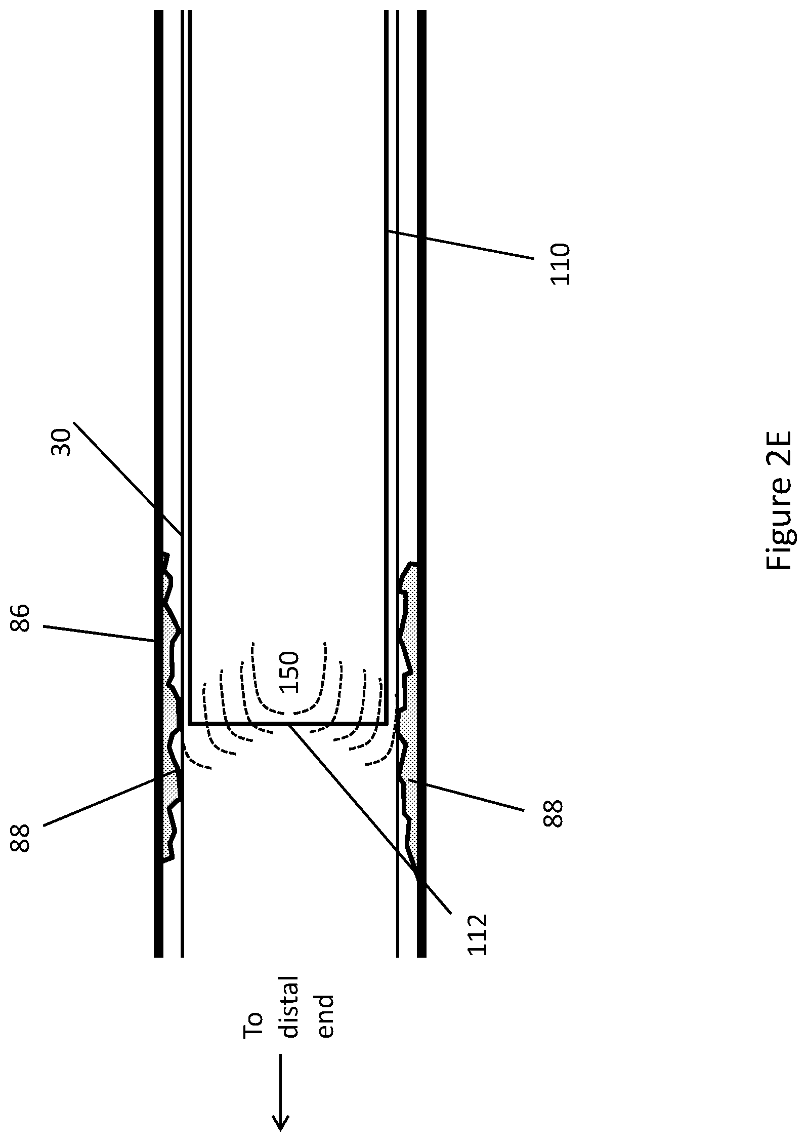 Patent US11771448 Figure 13 – System and method for lead extraction
