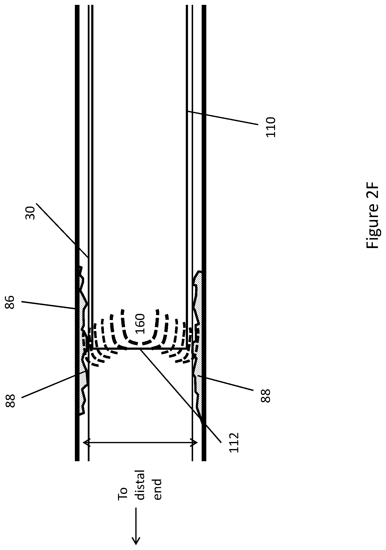 Patent US11771448 Figure 14 – System and method for lead extraction