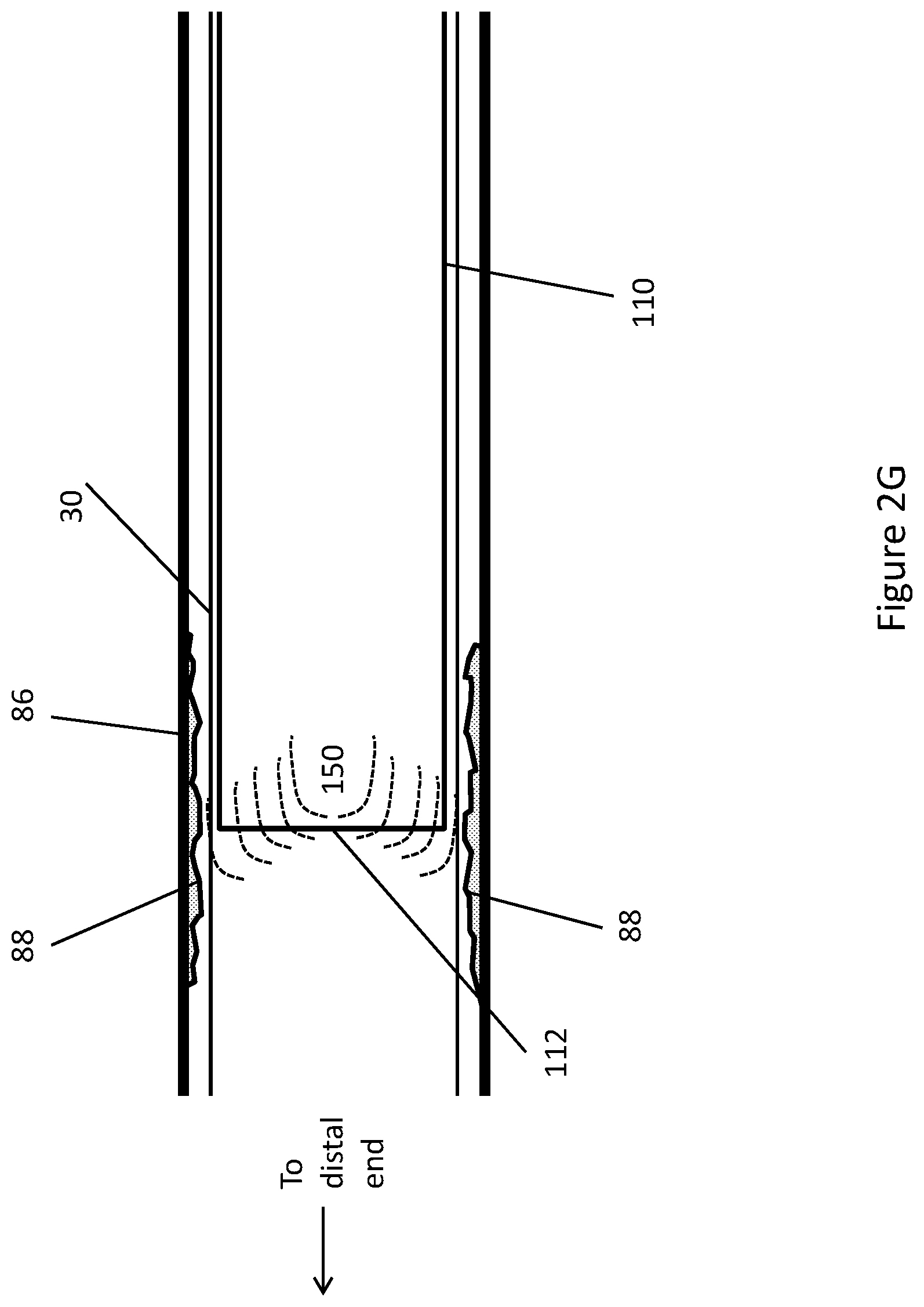 Patent US11771448 Figure 15 – System and method for lead extraction