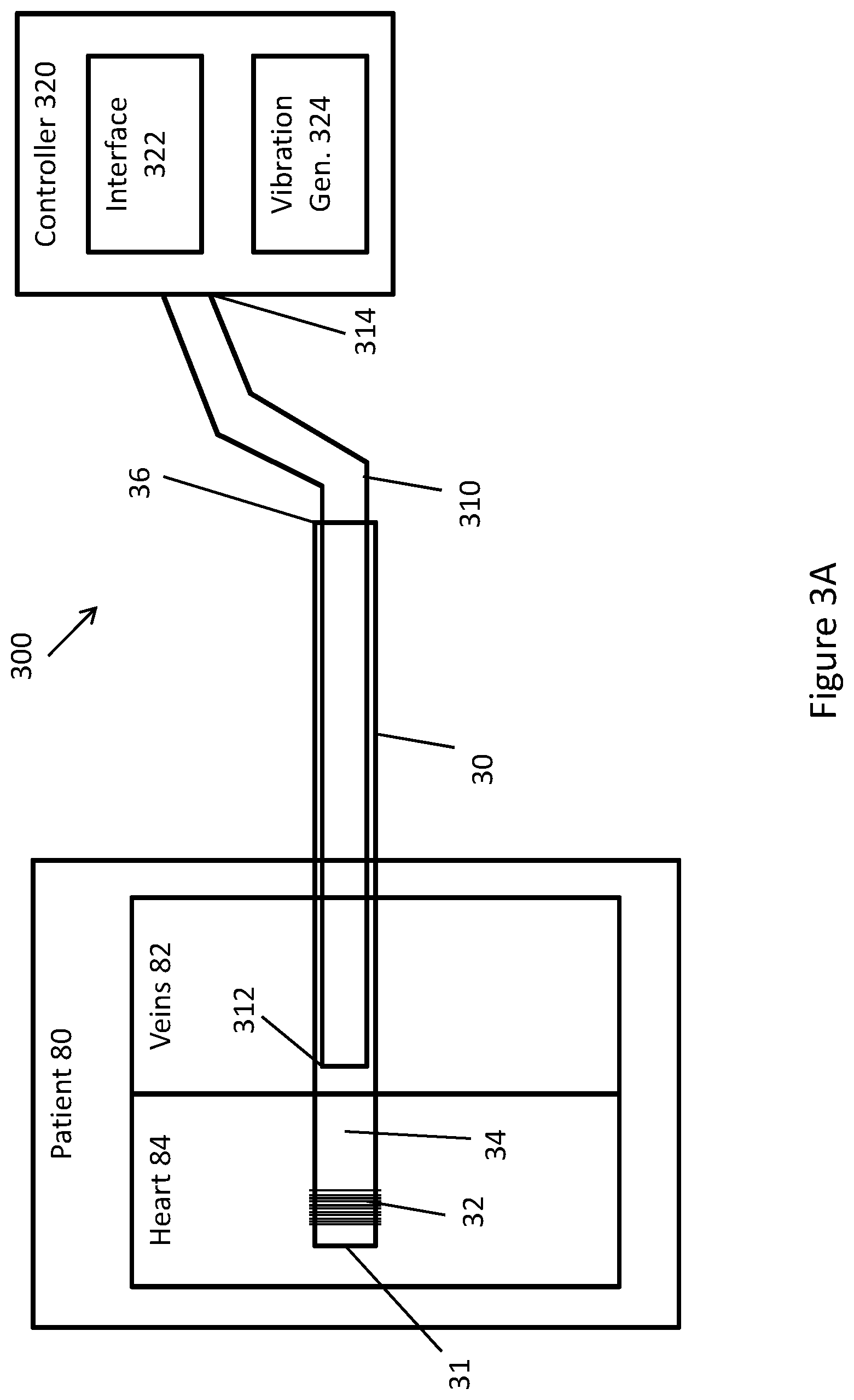 Patent US11771448 Figure 17 – System and method for lead extraction