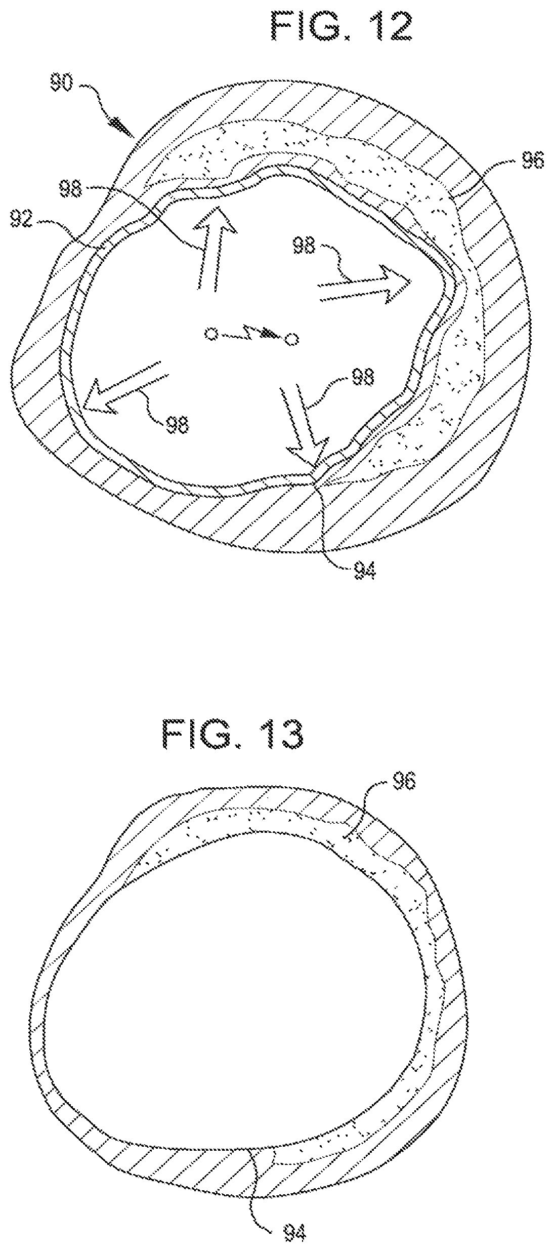 Patent US11771449 Figure 6 – Shockwave balloon catheter system