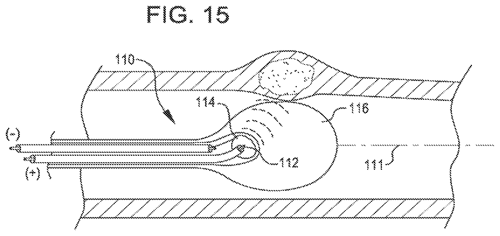Patent US11771449 Figure 8 – Shockwave balloon catheter system
