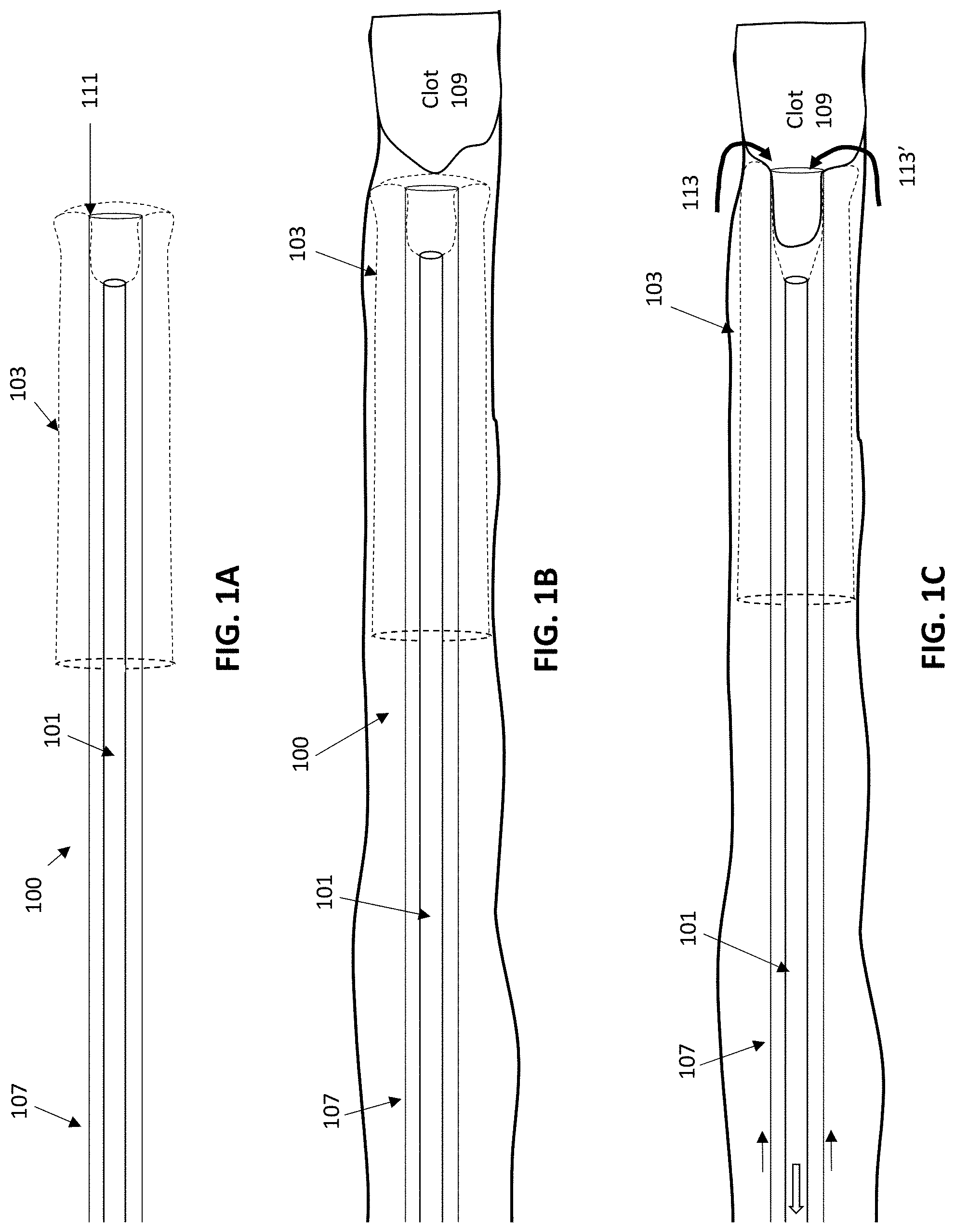 Patent US11771450 Figure 1 – Inverting thrombectomy apparatuses and methods of use