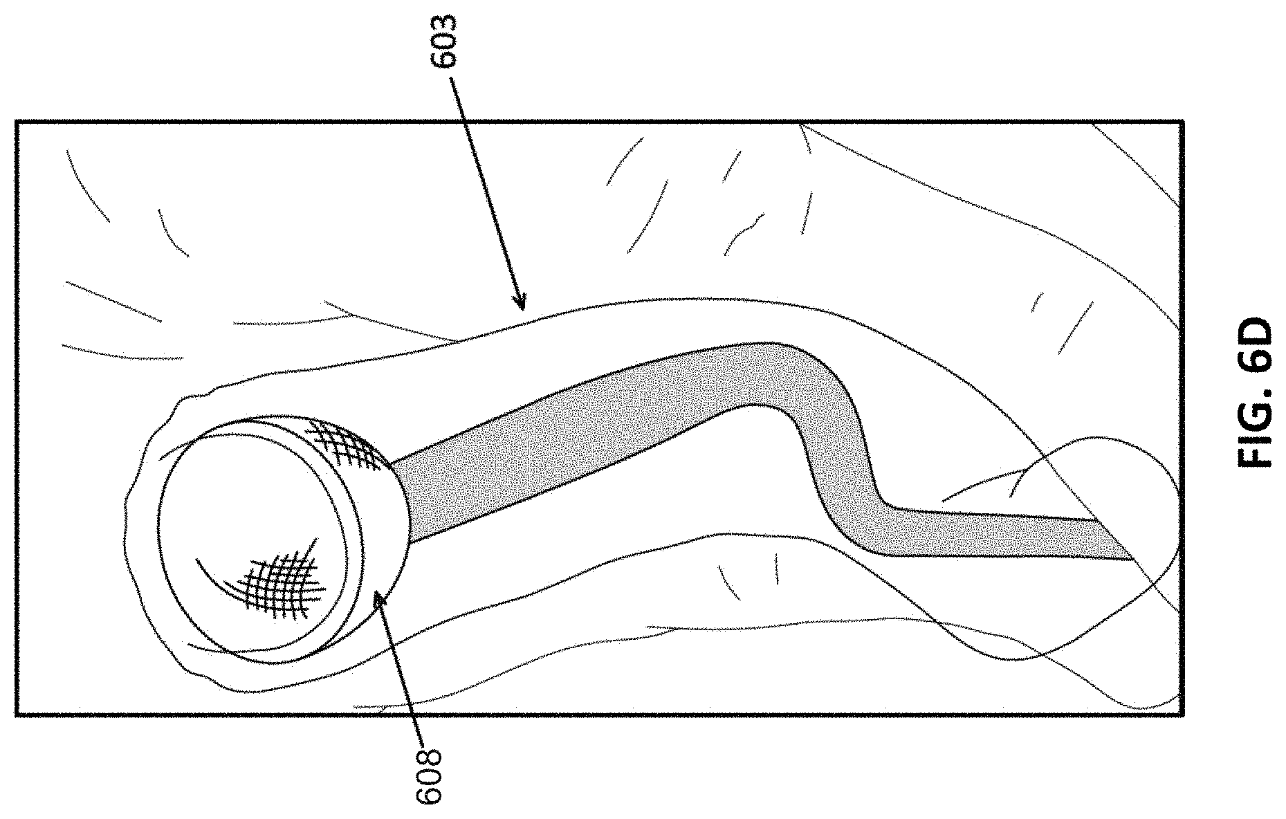 Patent US11771450 Figure 6 – Inverting thrombectomy apparatuses and methods of use