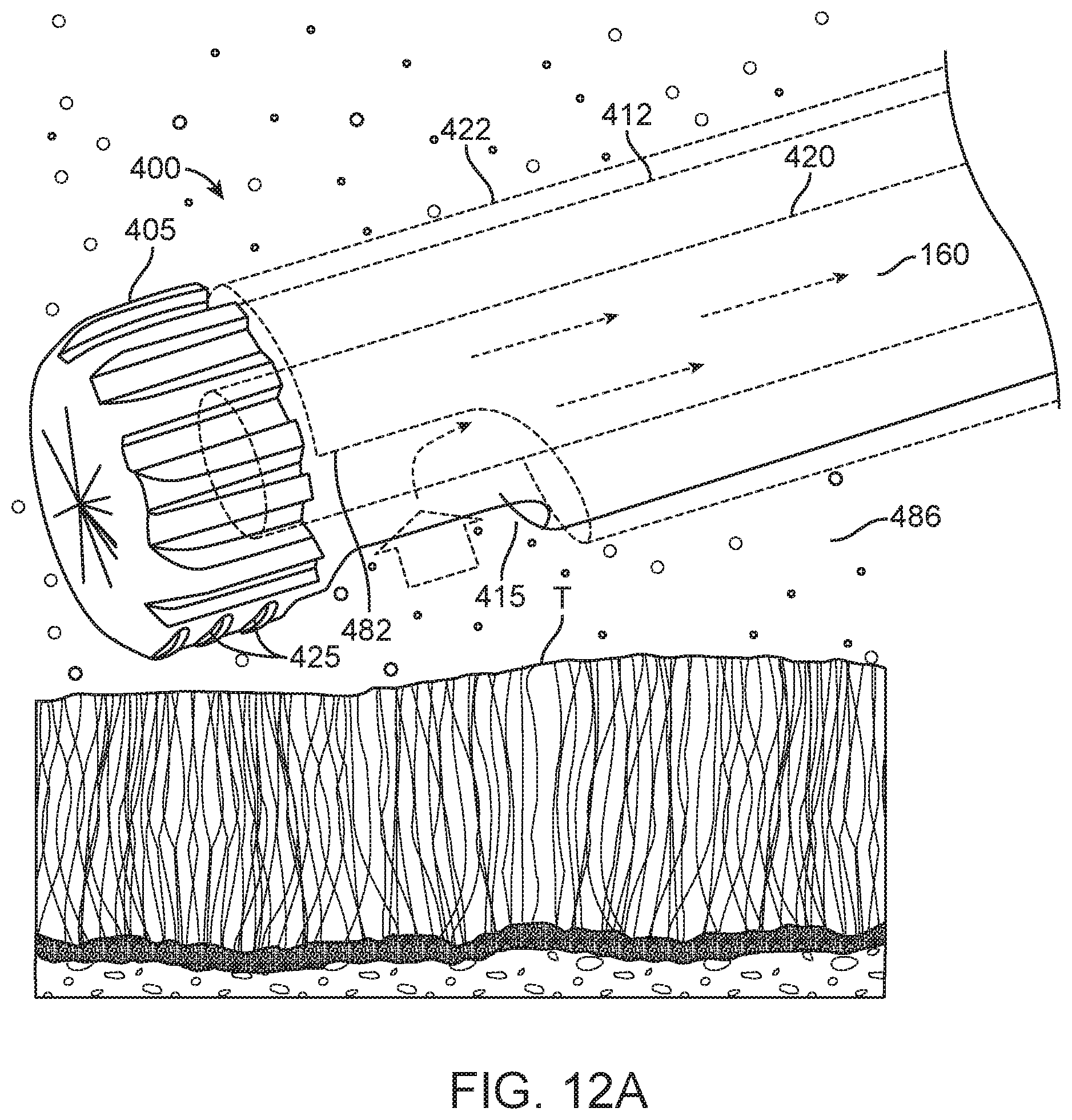 Patent US11771456 Figure 12 – Arthroscopic devices and methods
