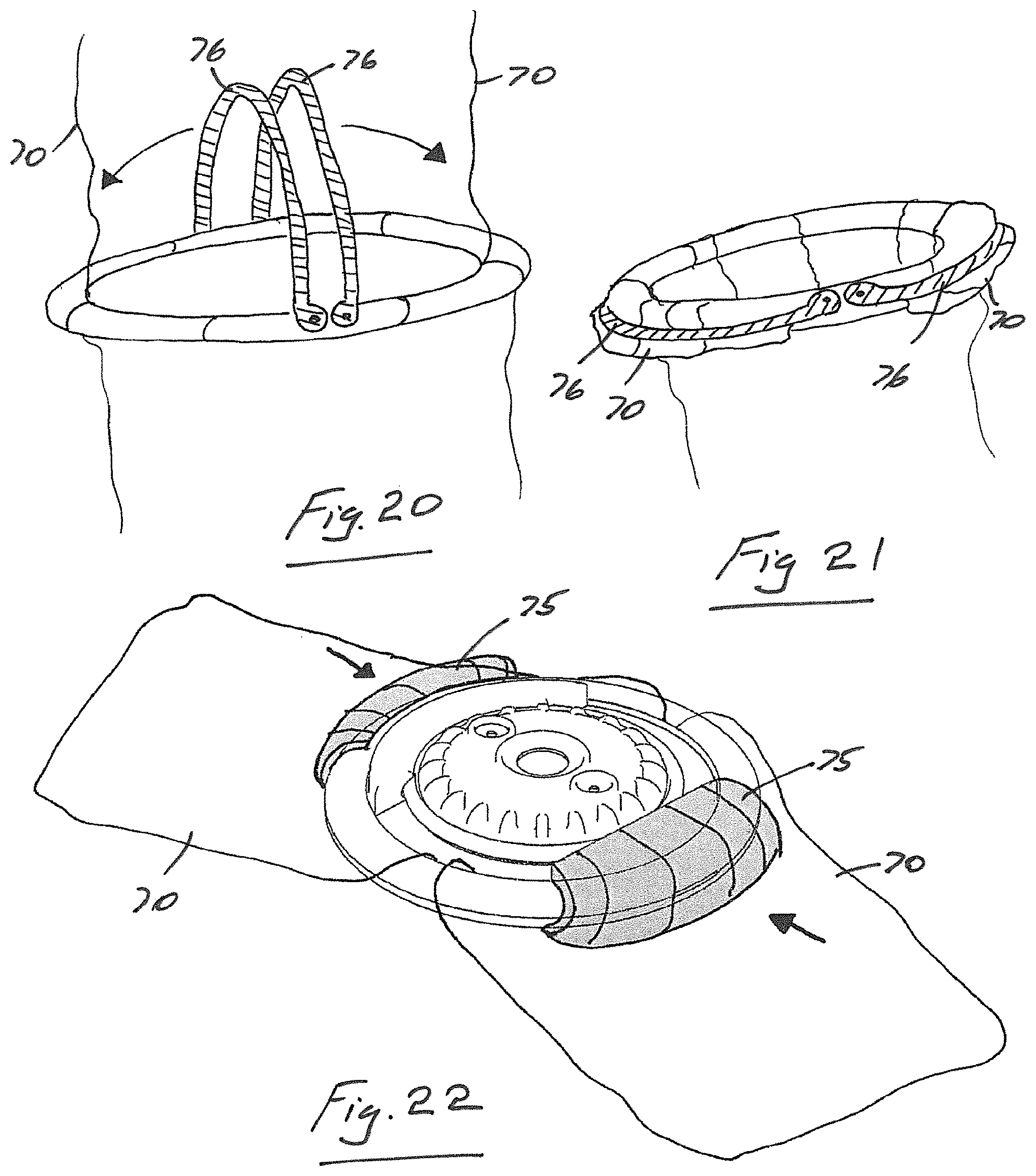 Patent US11771460 Figure 11 – Access port device