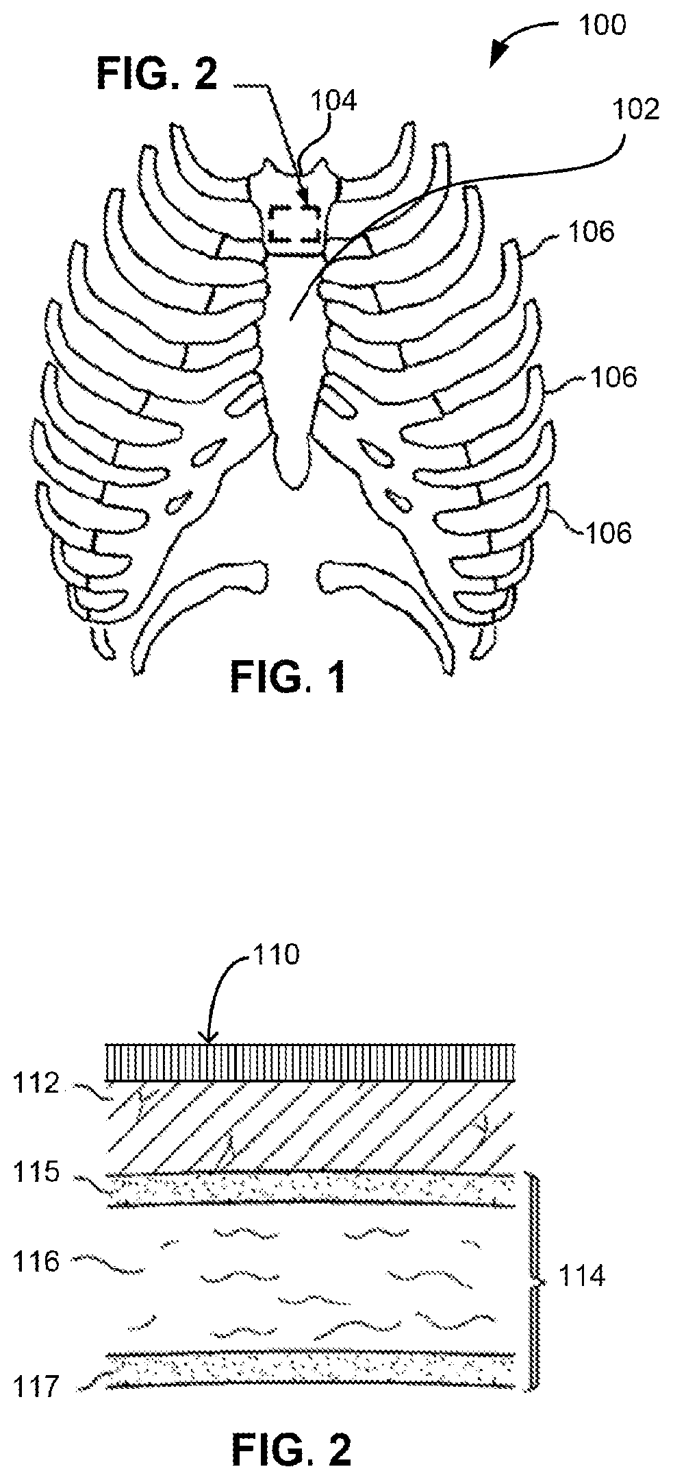 Patent US11771462 — Sternal locators and associated systems and methods — Figure 1