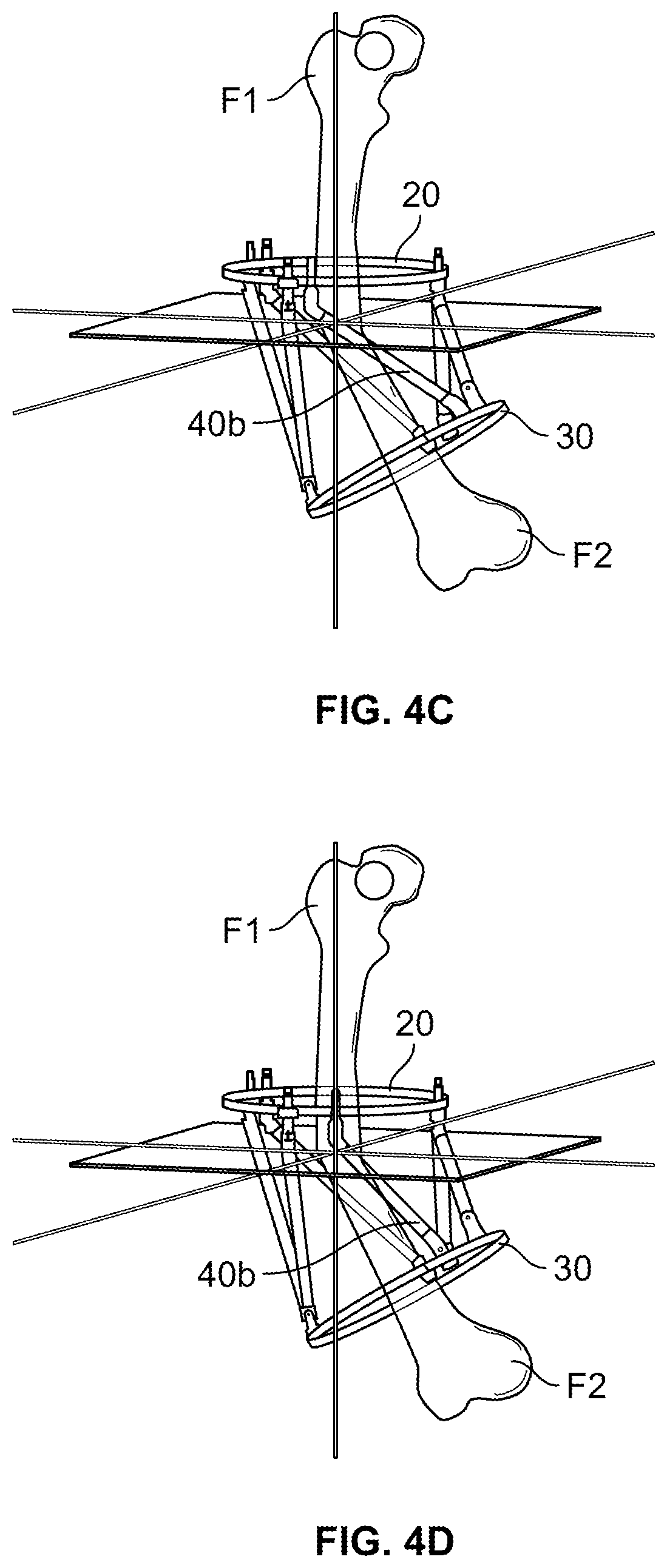 Patent US11771466 Figure 6 – Ring hole planning for external fixation frames