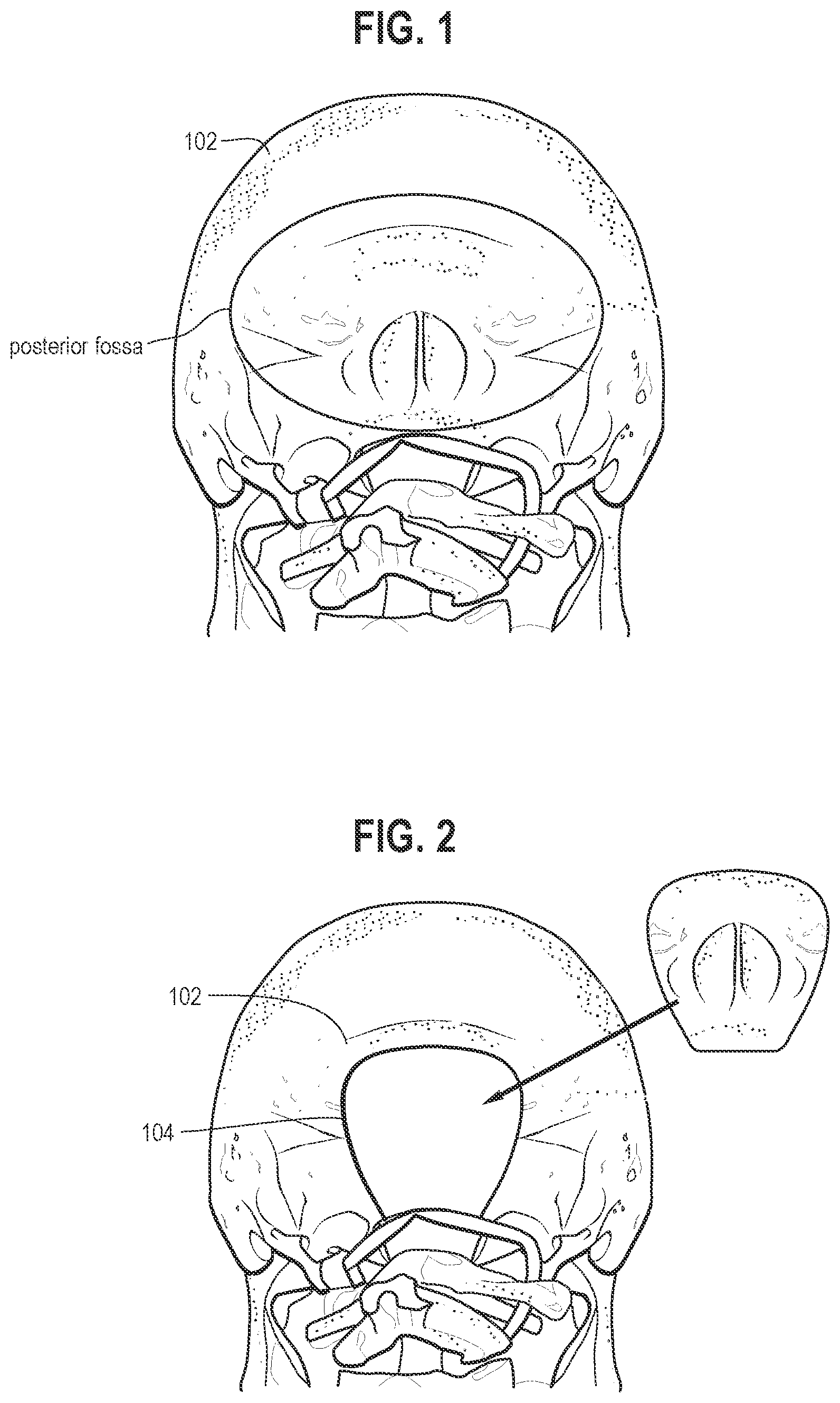 Patent US11771470 Figure 1 – Affixation device for securing bone flap