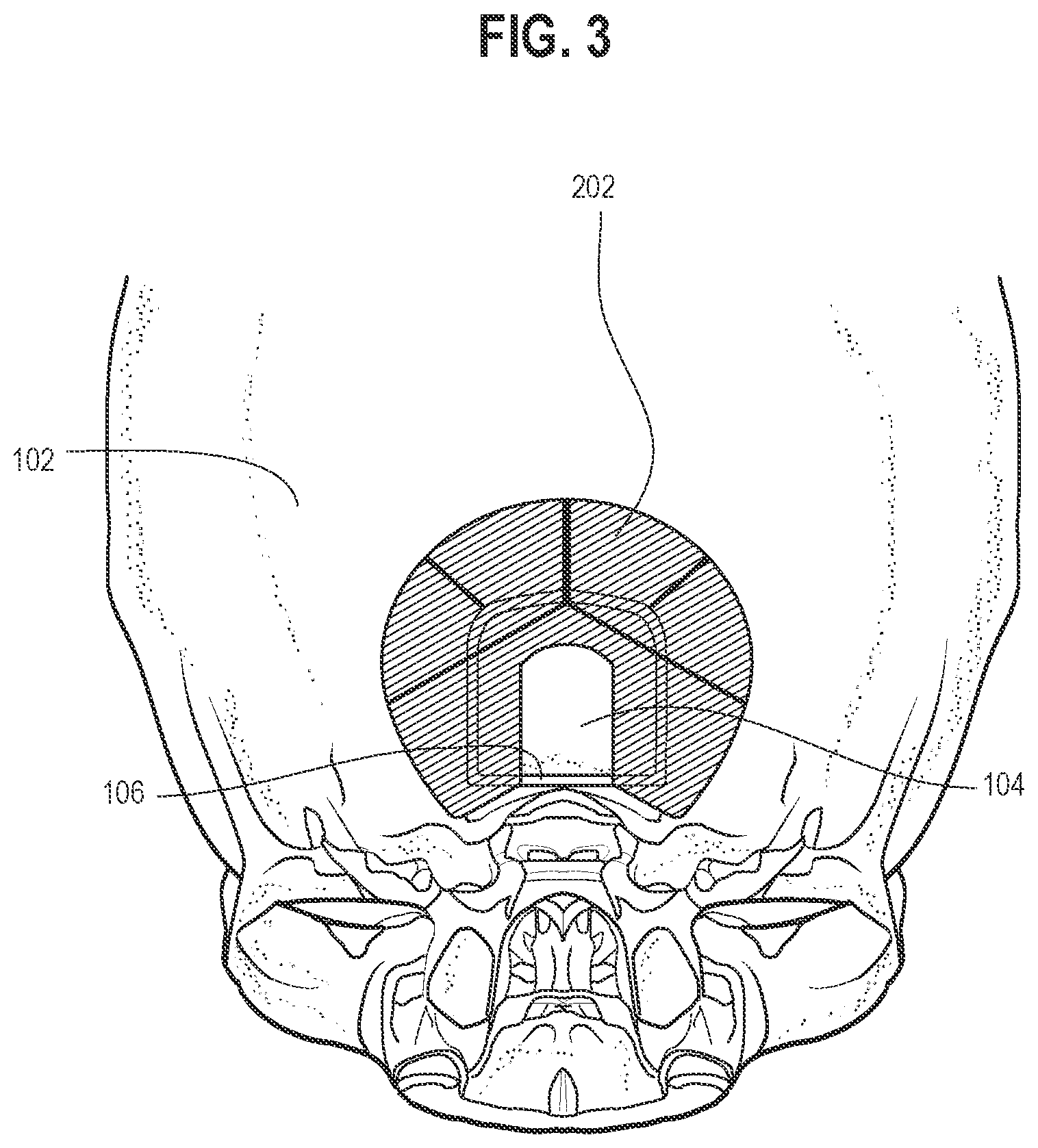 Patent US11771470 Figure 2 – Affixation device for securing bone flap