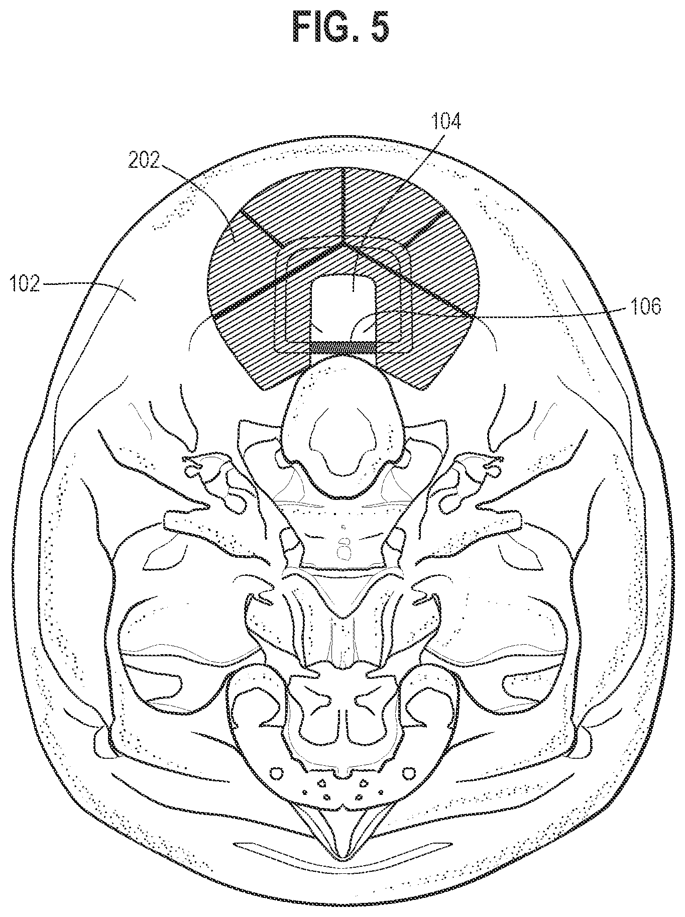 Patent US11771470 Figure 4 – Affixation device for securing bone flap