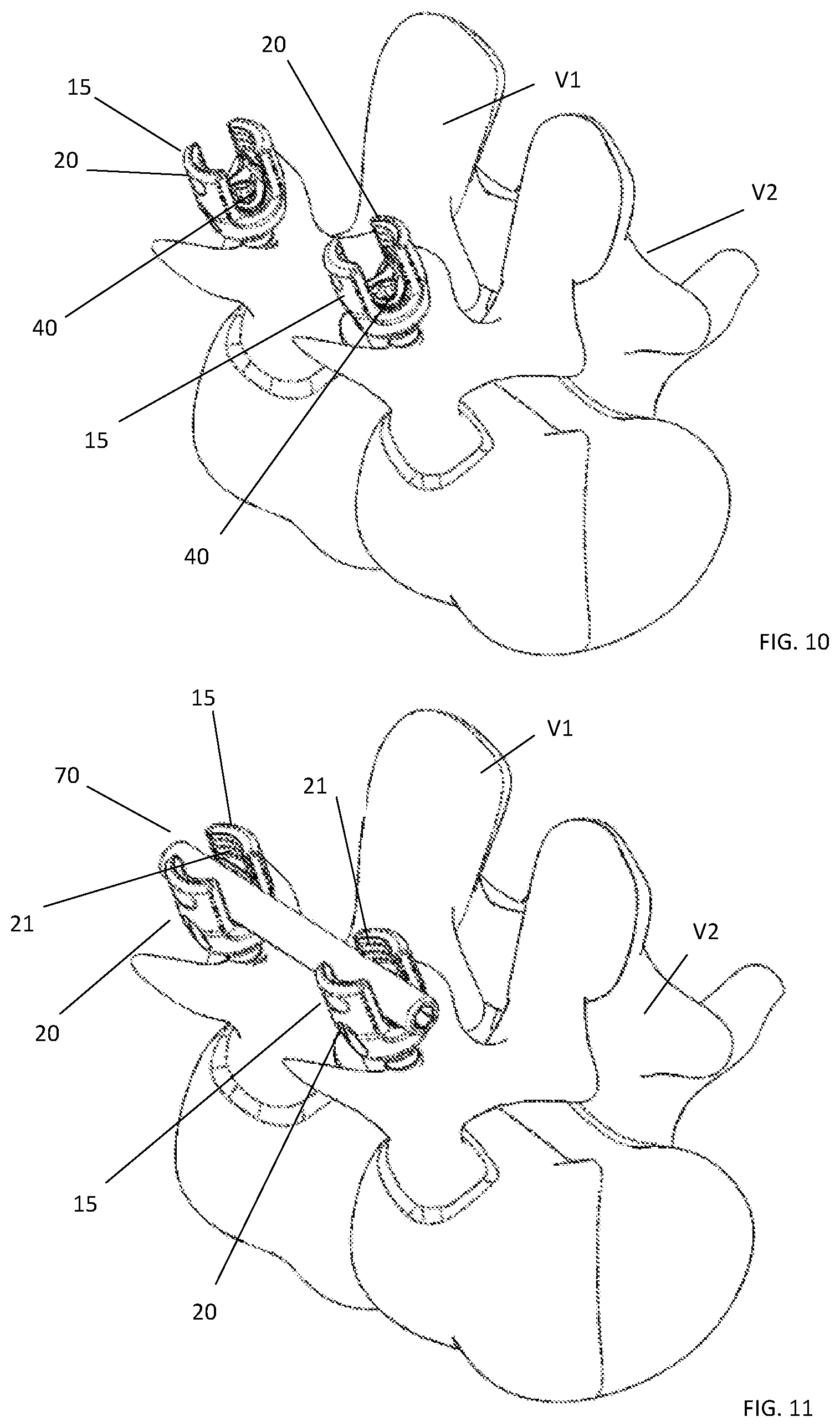 Patent US11771473 Figure 7 – Polyaxial pedicle screw