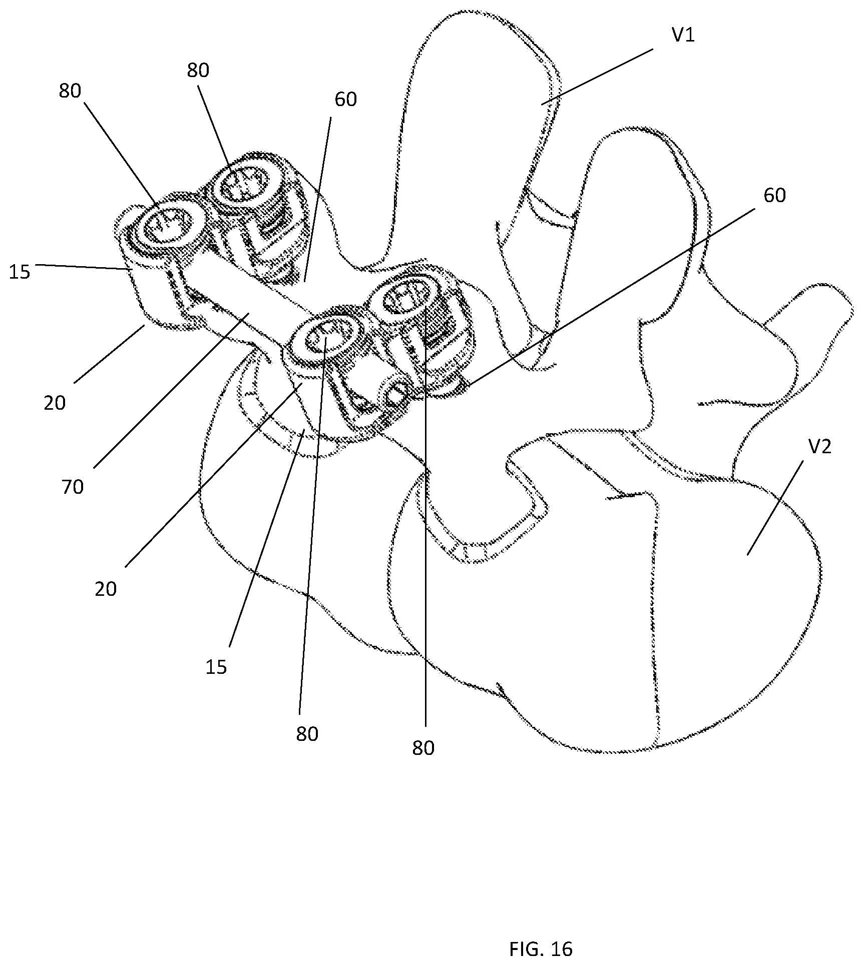 Patent US11771473 Figure 11 – Polyaxial pedicle screw