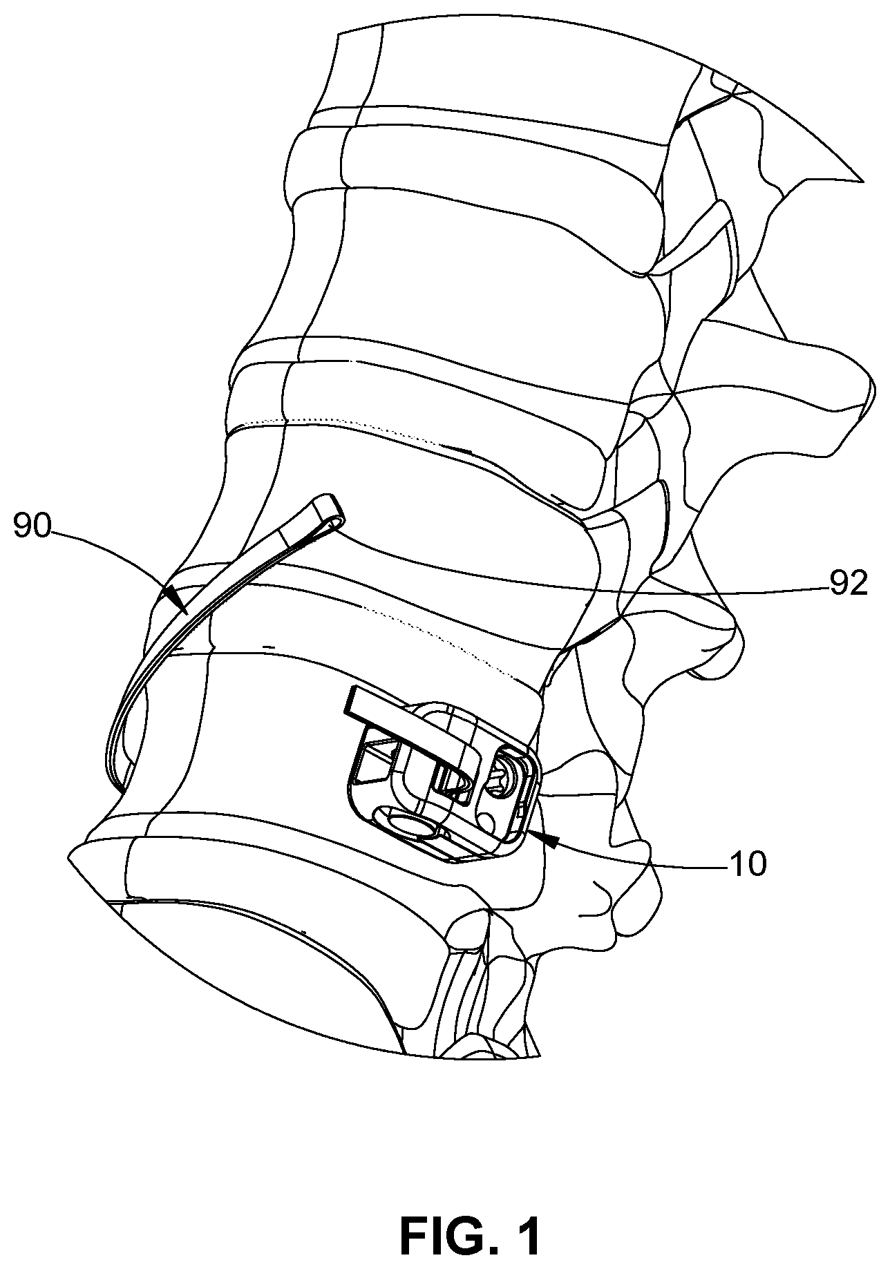 Patent US11771474 Figure 1 – Band tensioning system
