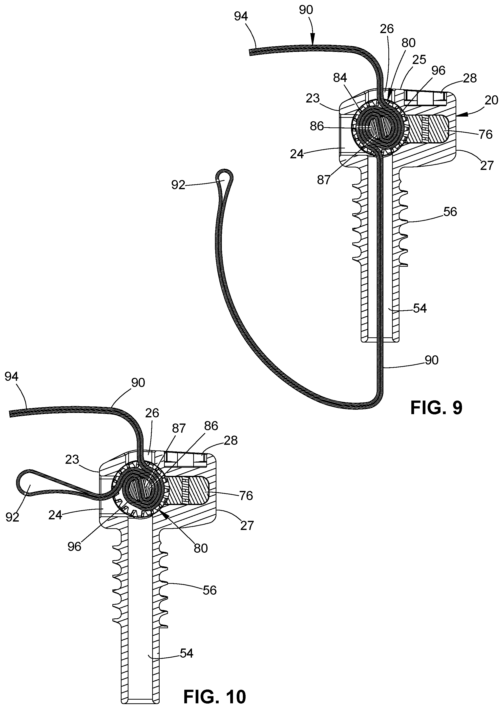 Patent US11771474 Figure 4 – Band tensioning system