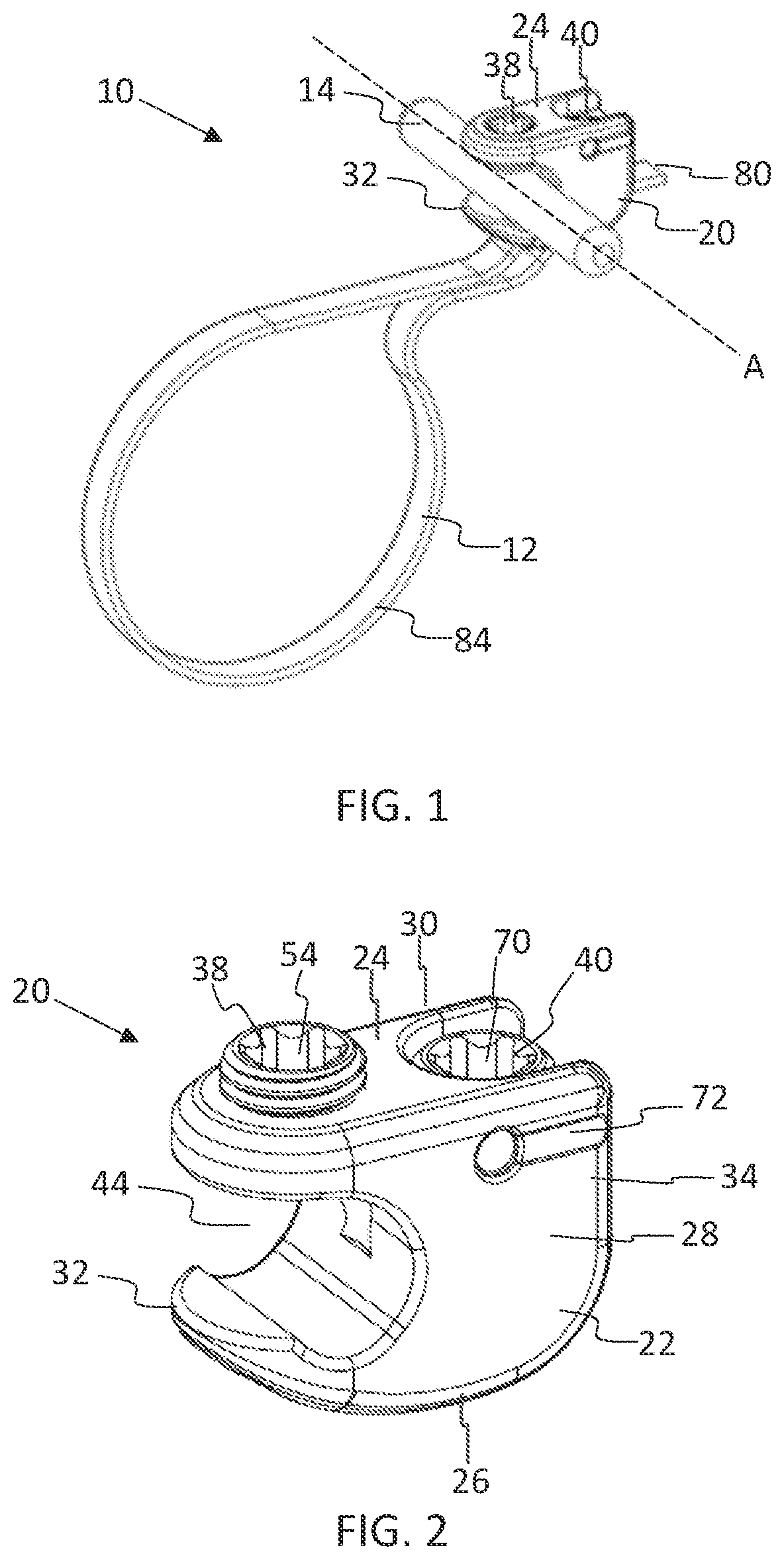 Patent US11771475 Figure 1 – Systems and methods for surgical procedures using band clamp implants and tensioning instruments