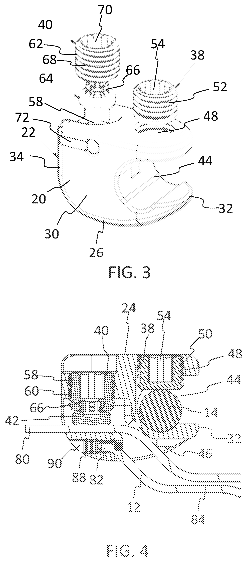 Patent US11771475 Figure 2 – Systems and methods for surgical procedures using band clamp implants and tensioning instruments