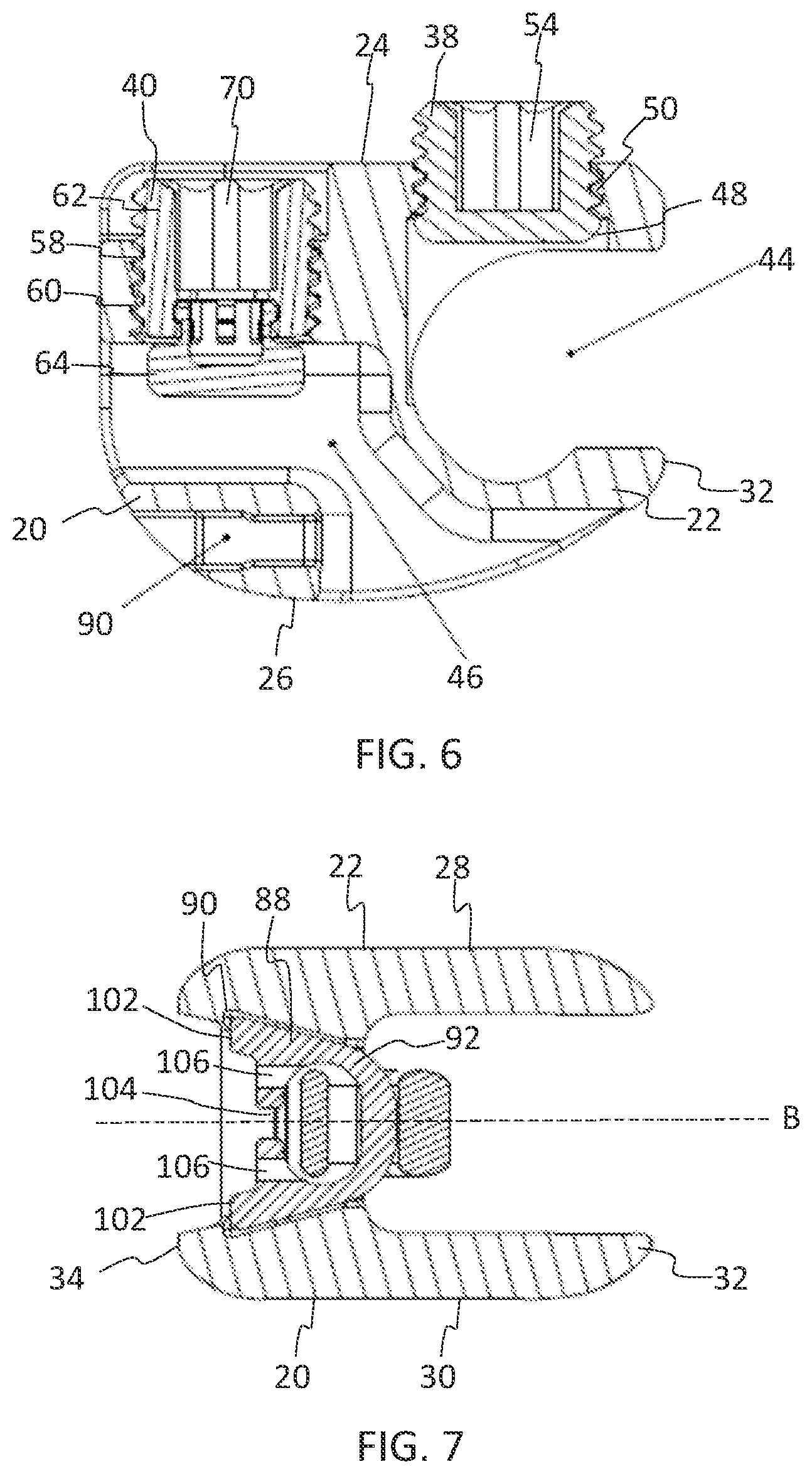 Patent US11771475 Figure 4 – Systems and methods for surgical procedures using band clamp implants and tensioning instruments