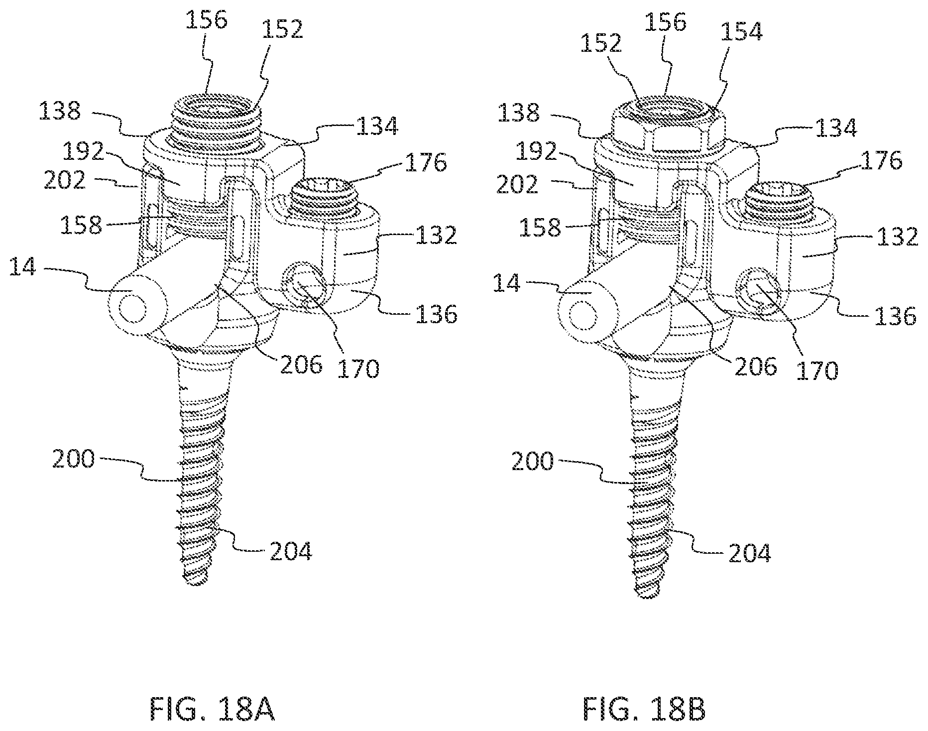 Patent US11771475 Figure 11 – Systems and methods for surgical procedures using band clamp implants and tensioning instruments